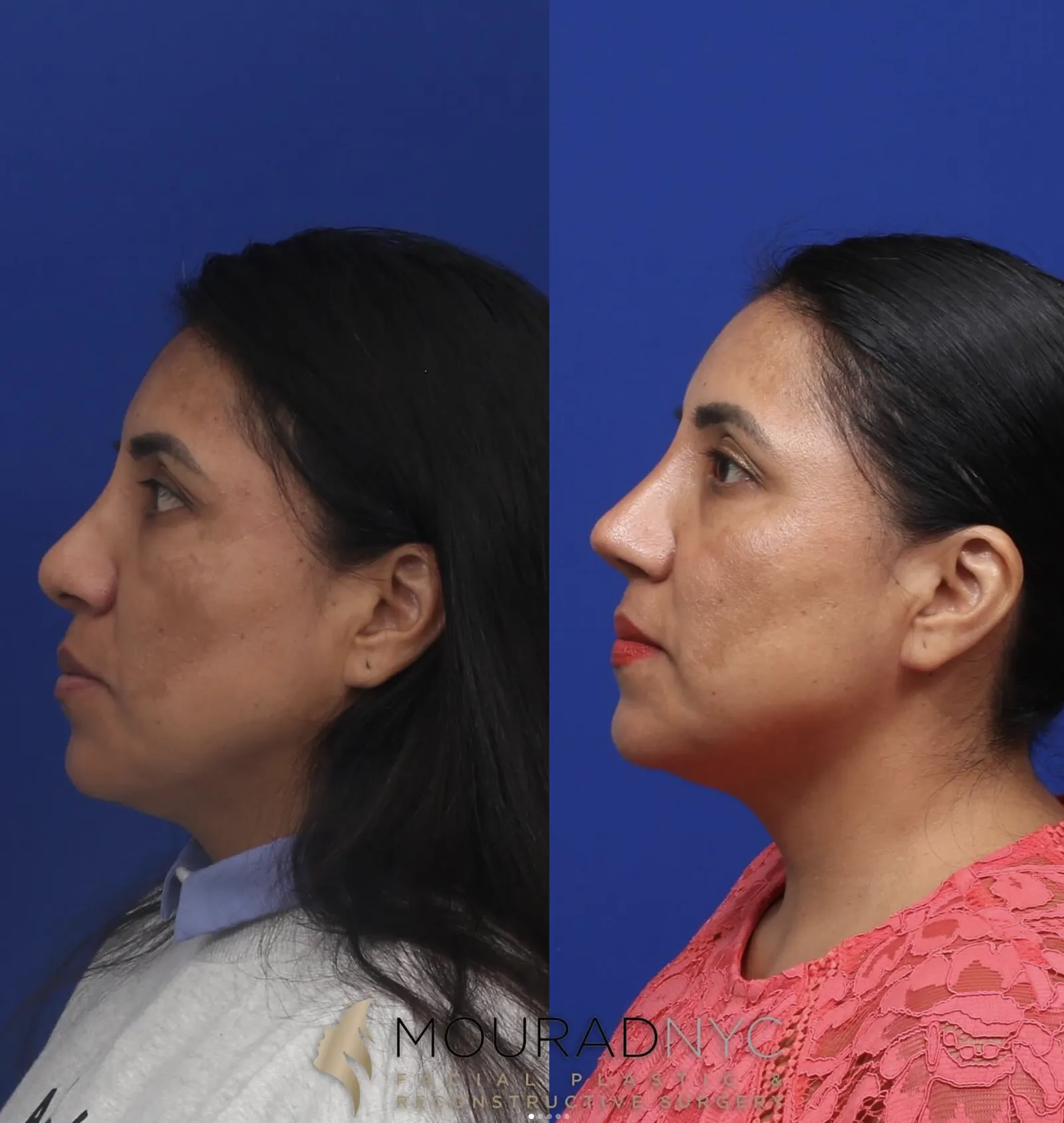 Left lateral profile comparison of a female patient in her 40s before and after revision rhinoplasty with rib graft