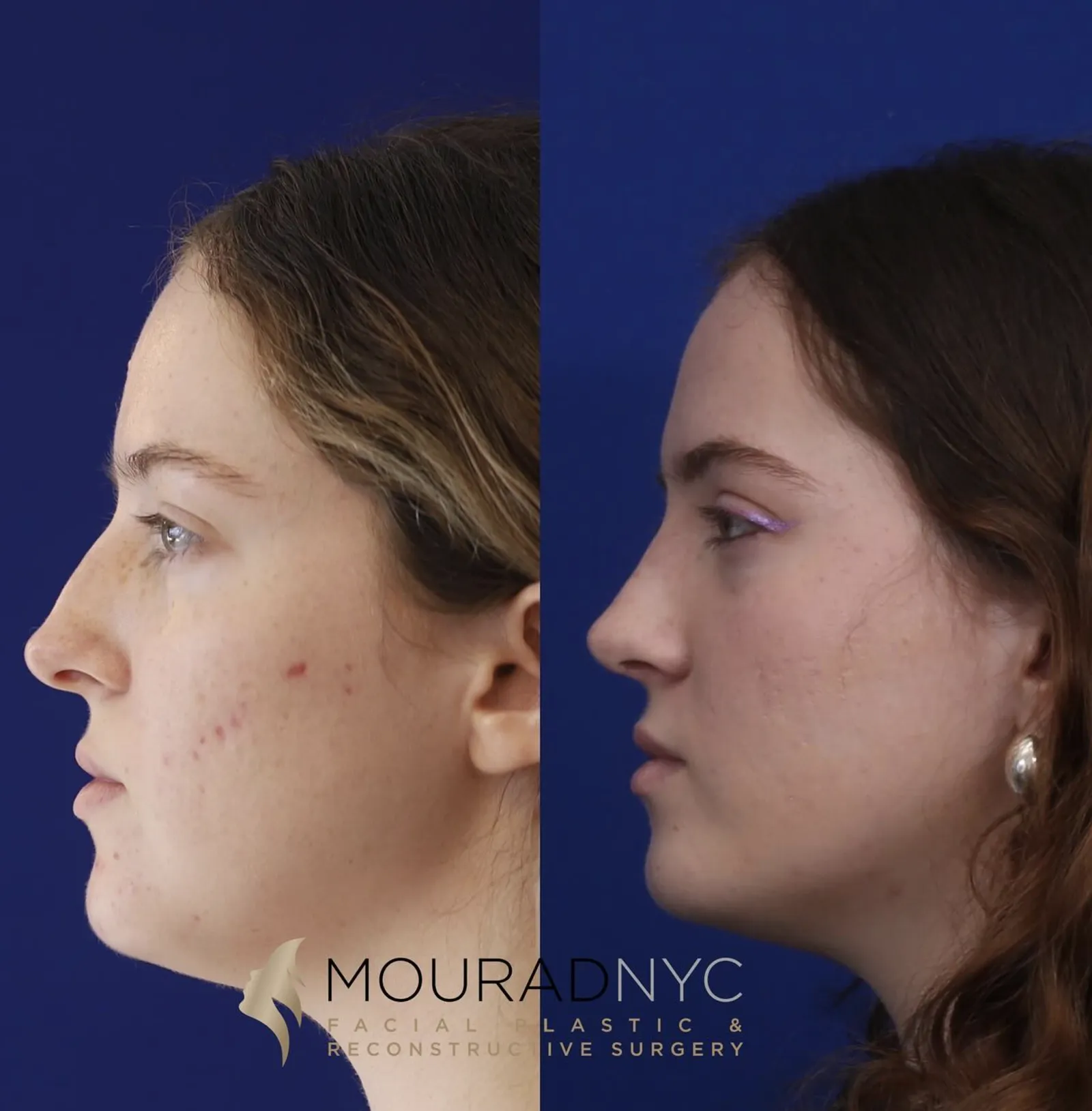 Right lateral profile comparison of a female patient in her 20s before and after primary rhinoplasty