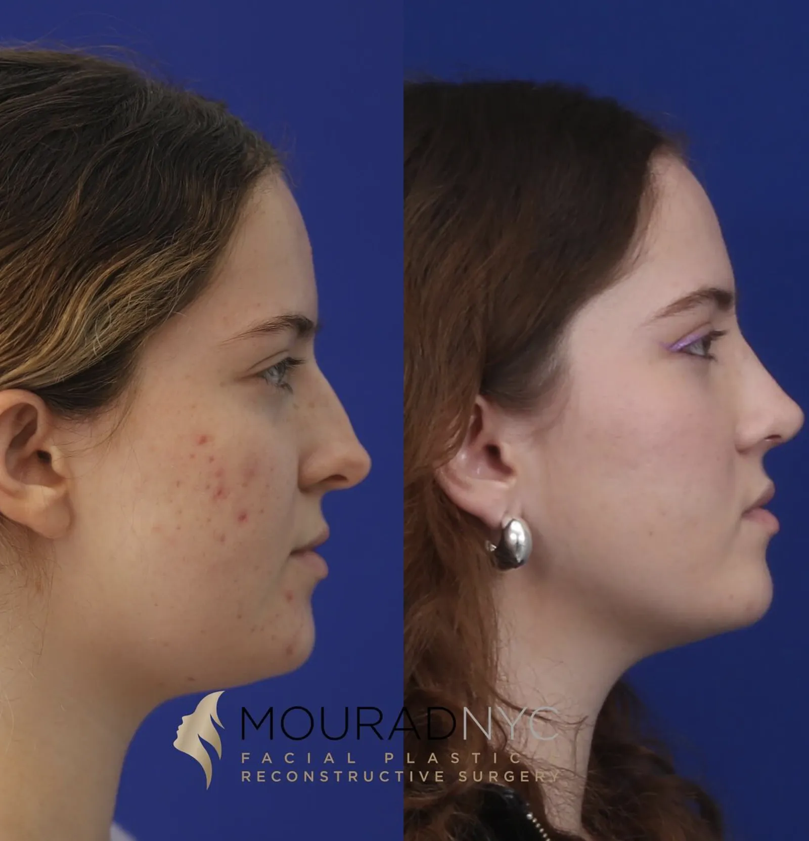 Left lateral profile comparison of a female patient in her 20s before and after primary rhinoplasty