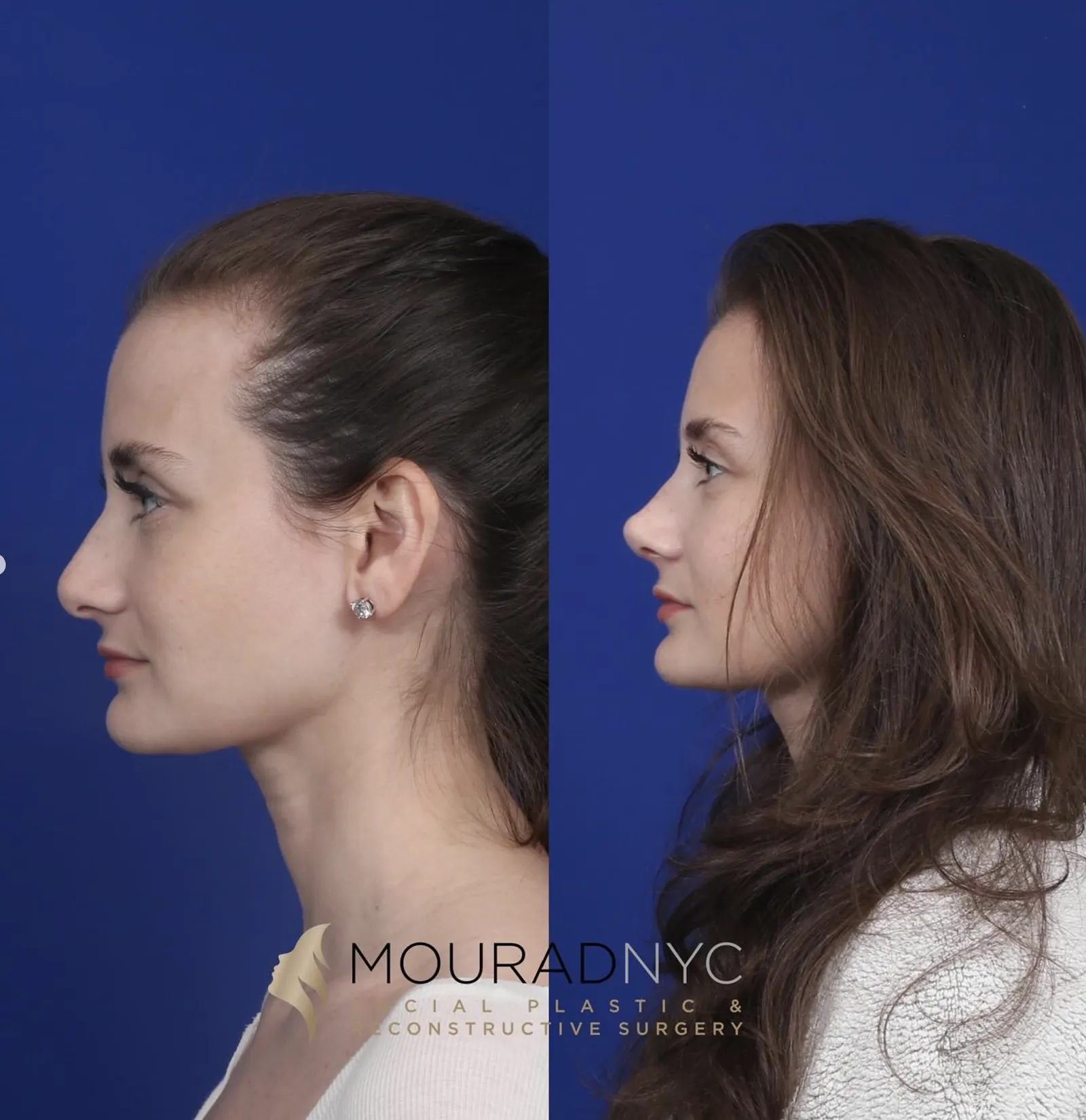 Right lateral profile comparison of a female patient in her 20s before and after primary rhinoplasty