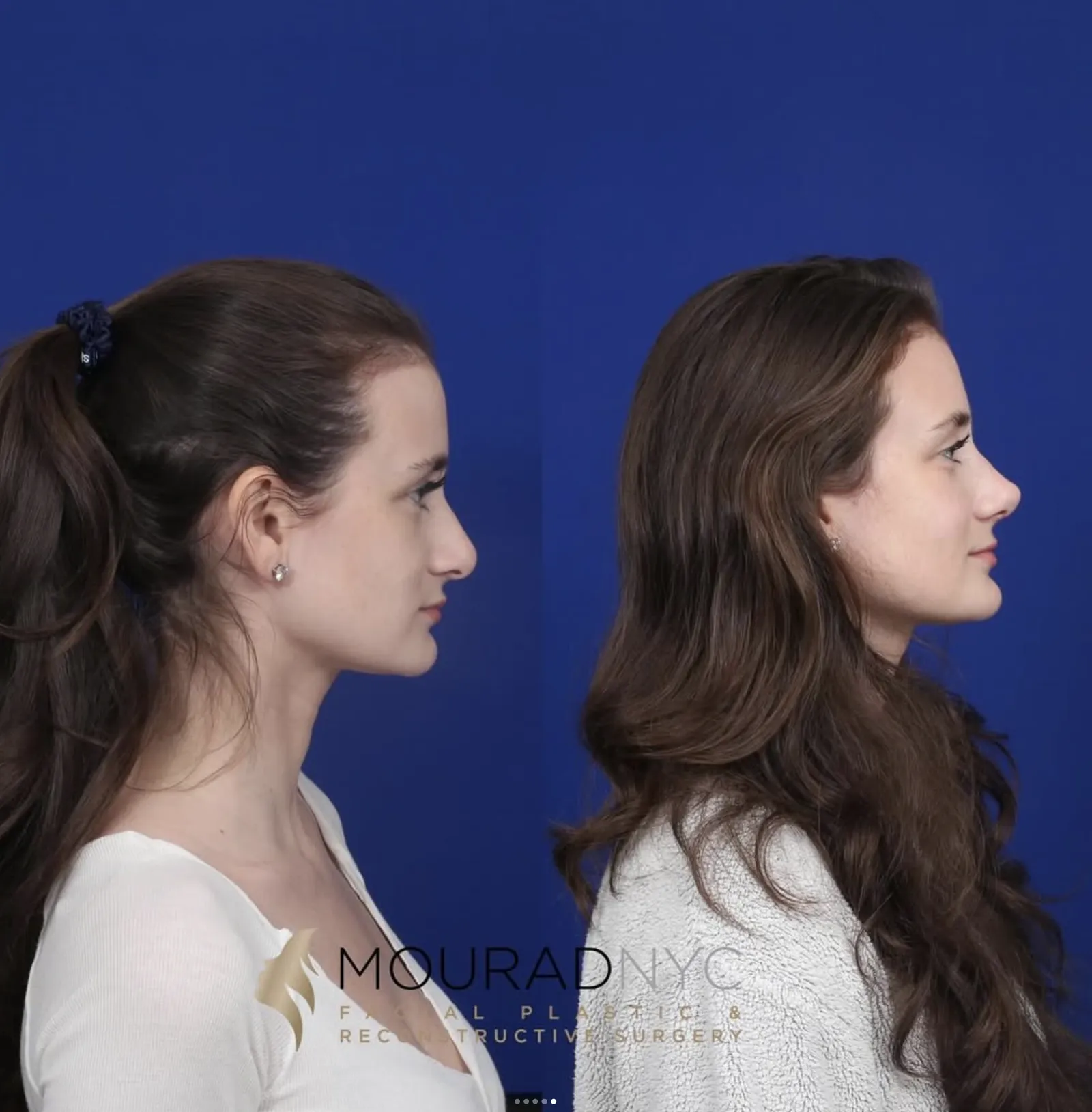 Left lateral profile comparison of a female patient in her 20s before and after primary rhinoplasty