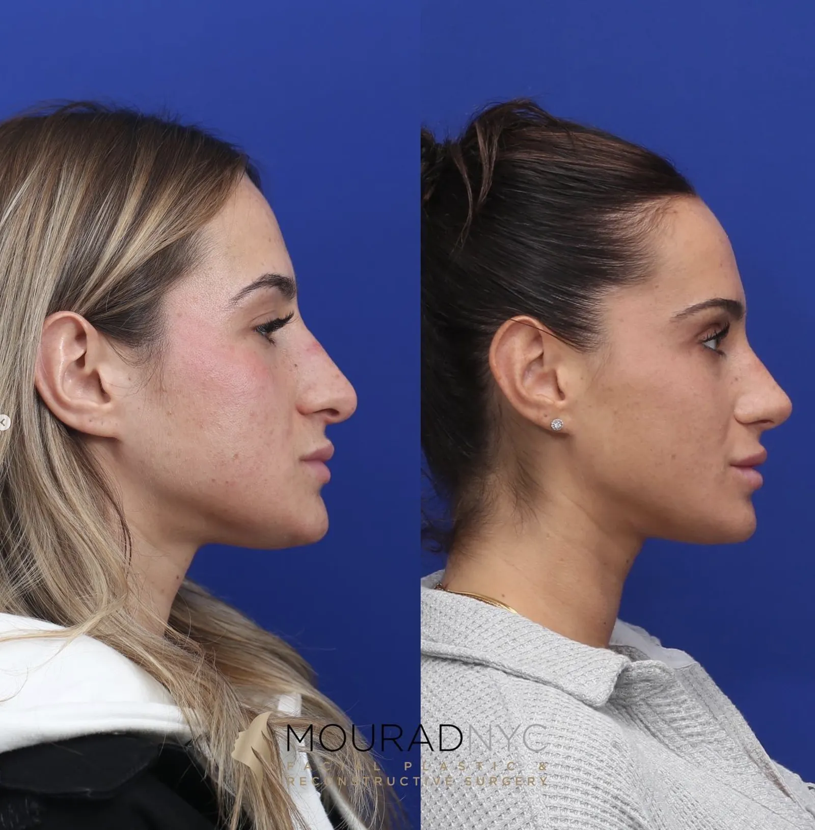 Left lateral profile comparison of a female patient in her 20s before and after primary rhinoplasty