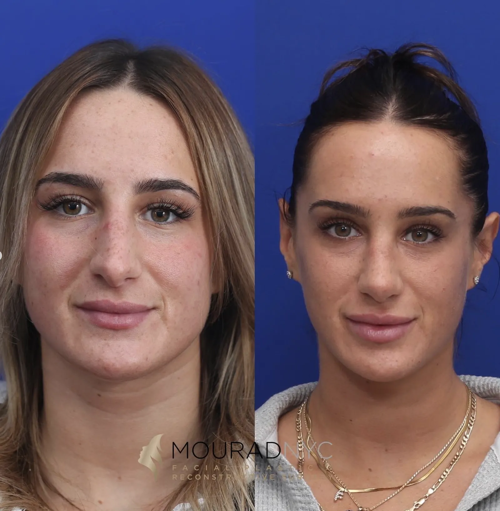 Frontal comparison of a female patient in her 20s before and after primary rhinoplasty