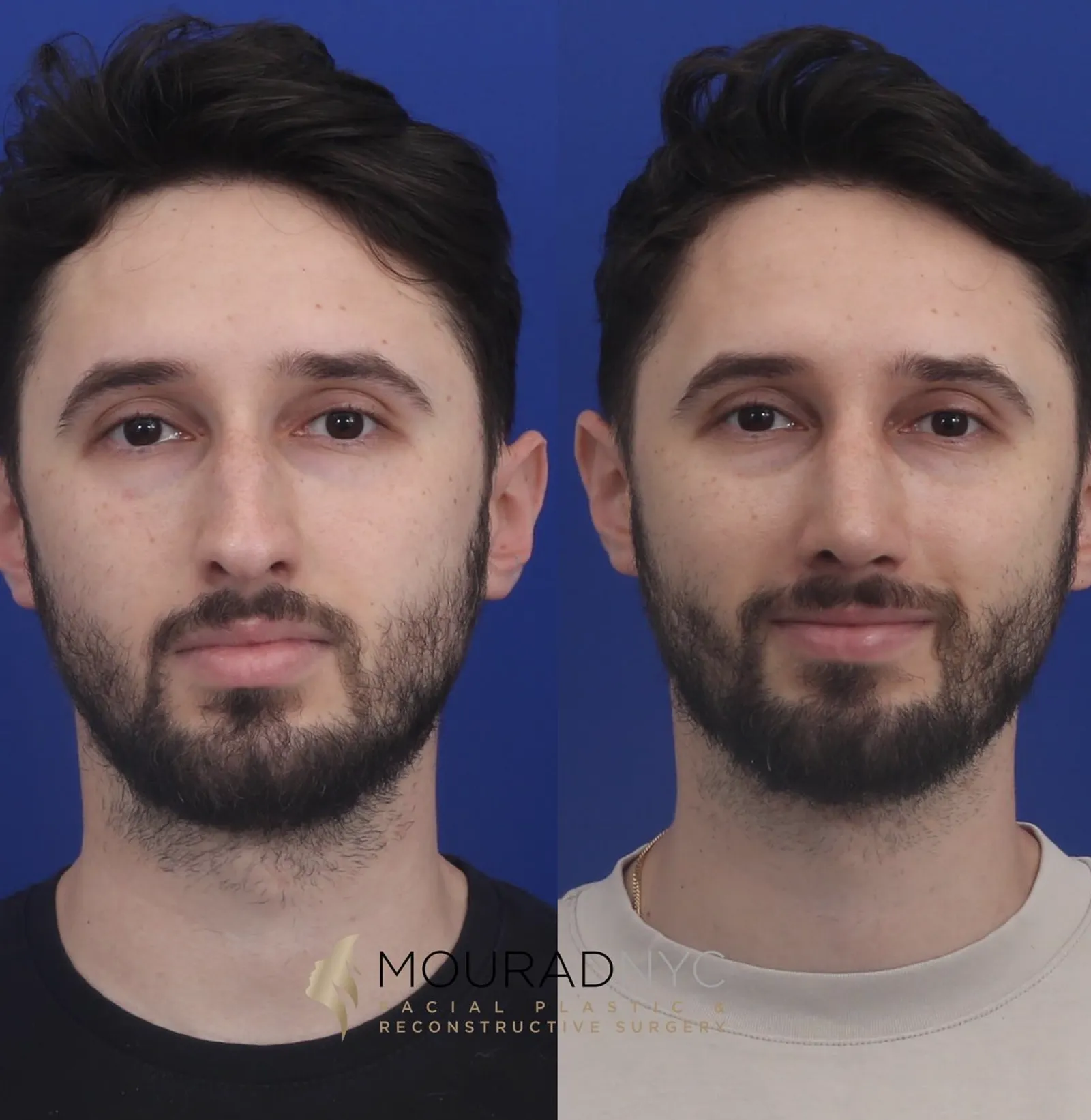 Frontal comparison of a male patient in his 20s before and after primary rhinoplasty