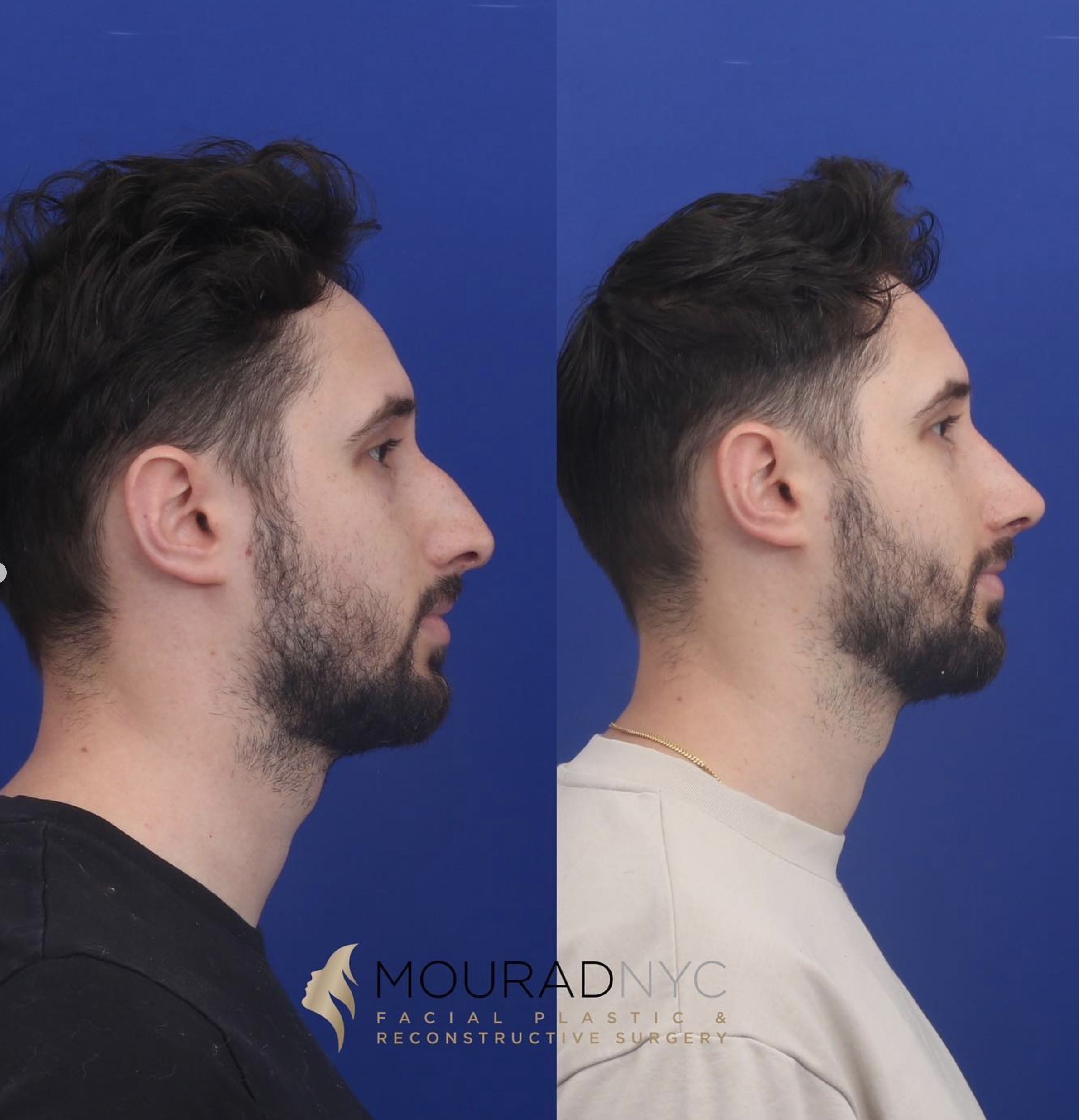 Left lateral profile comparison before and after male primary rhinoplasty