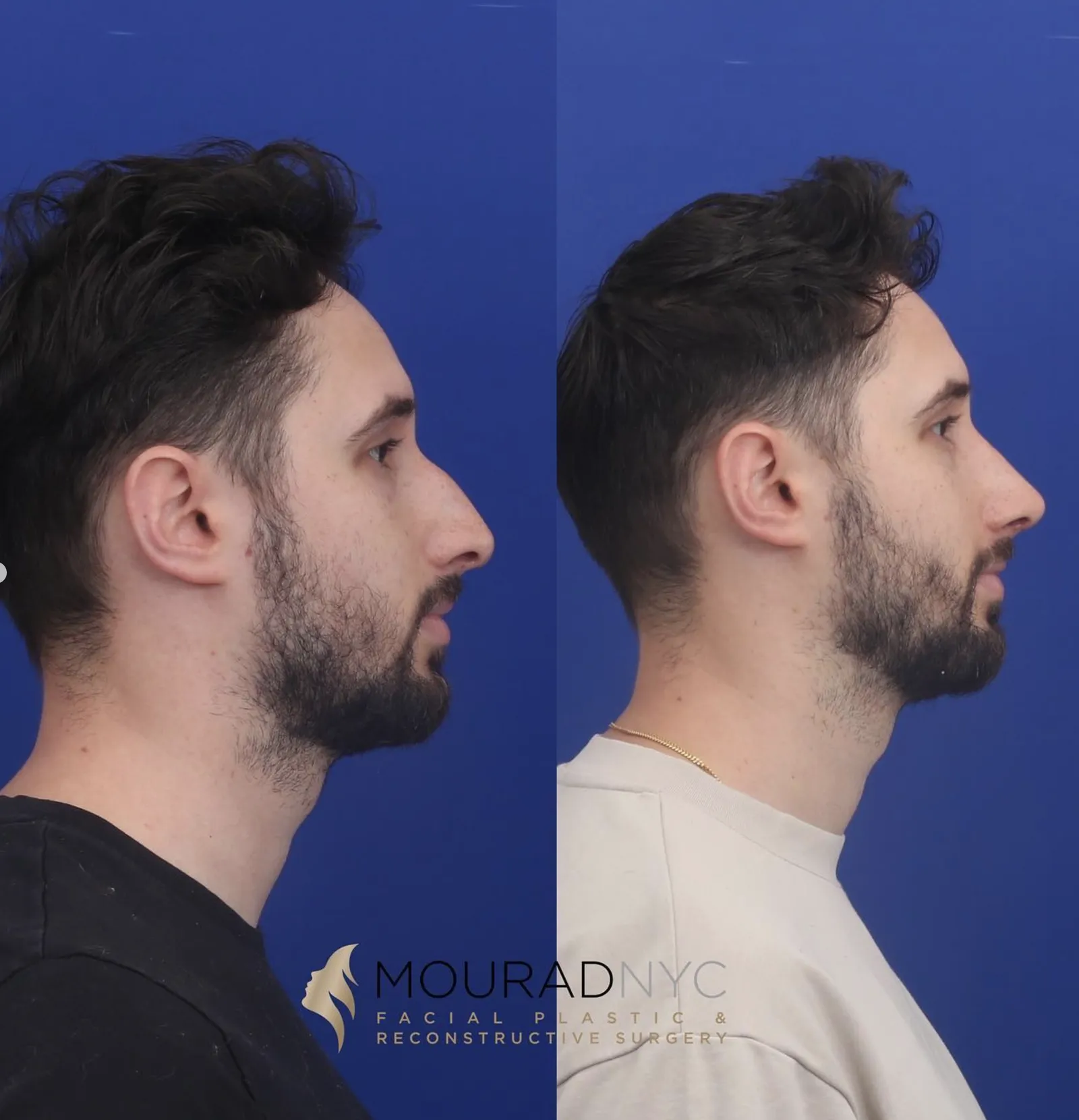 Left lateral profile comparison of a male patient in his 20s before and after primary rhinoplasty