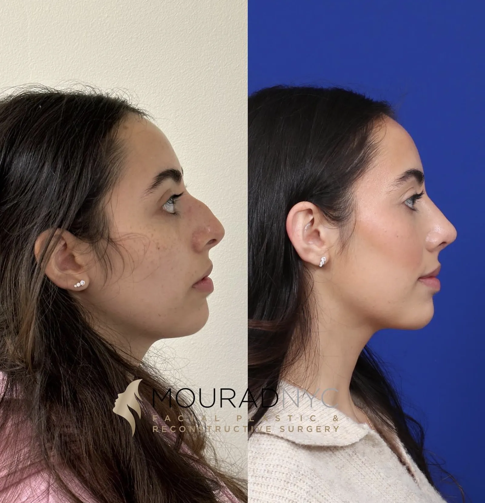 Right lateral profile comparison of a female patient in her 20s before and after primary rhinoplasty