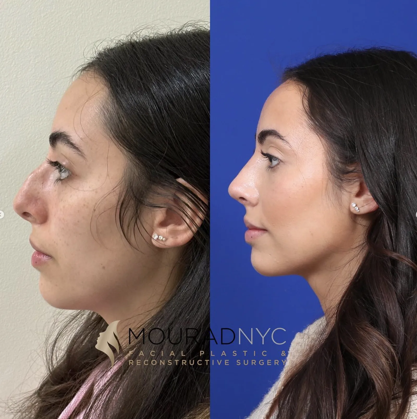 Left lateral profile comparison of a female patient in her 20s before and after primary rhinoplasty