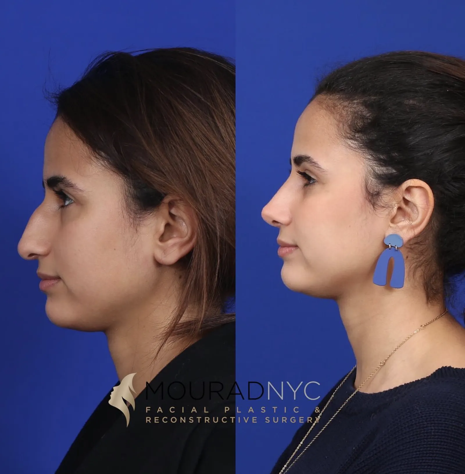 Right lateral profile comparison of a female patient in her 20s before and after primary rhinoplasty