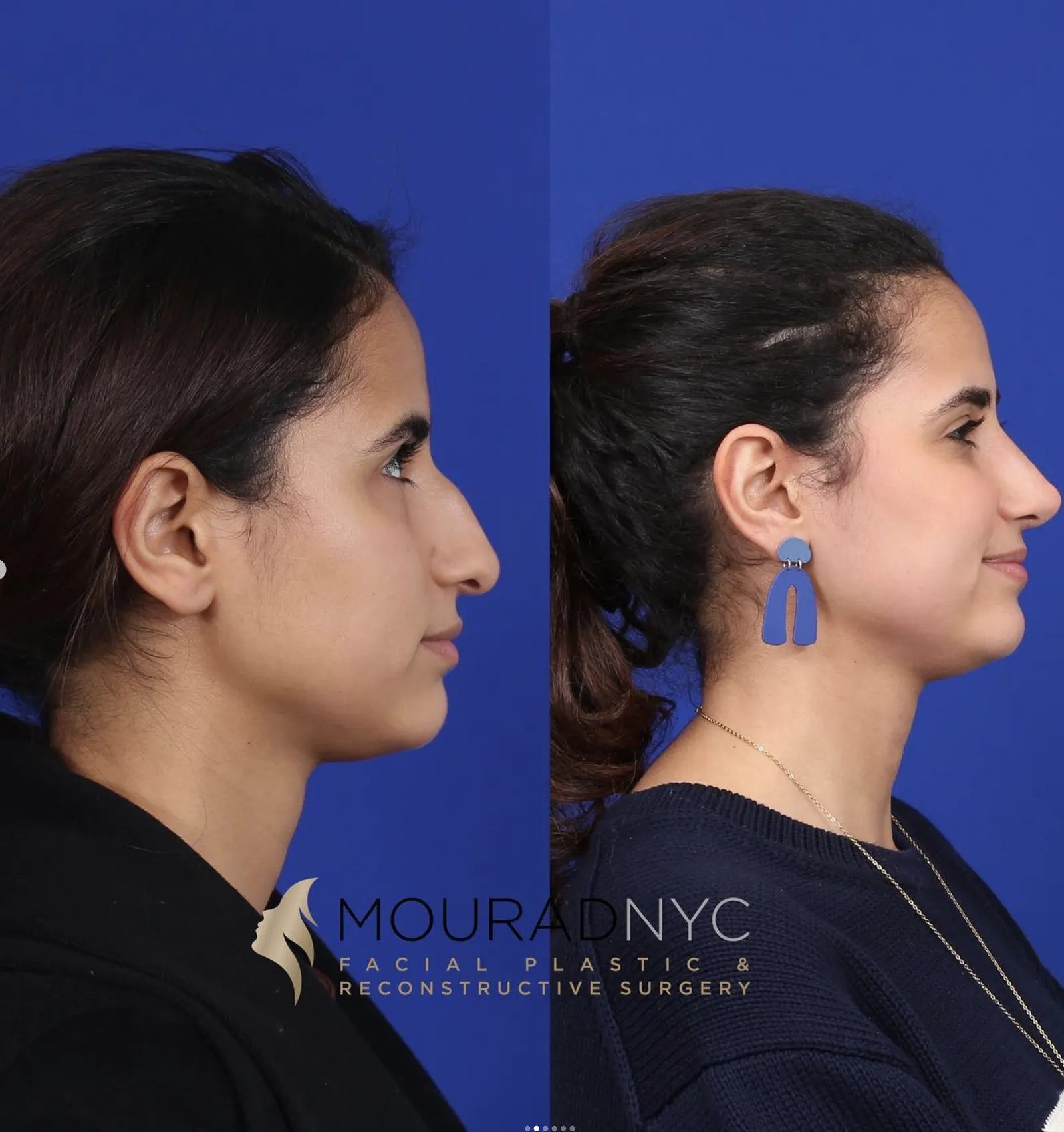 Left lateral profile comparison of a female patient in her 20s before and after primary rhinoplasty