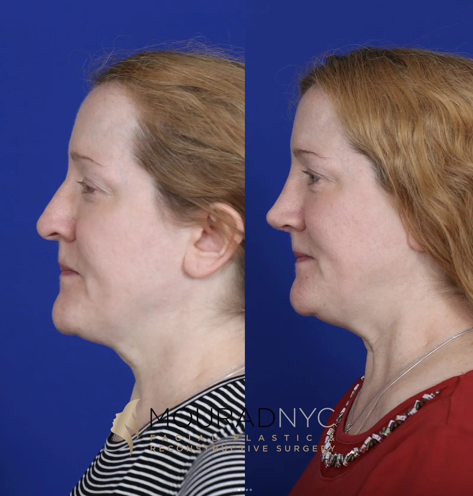 Right lateral profile comparison of a female patient in her 40s before and after primary rhinoplasty