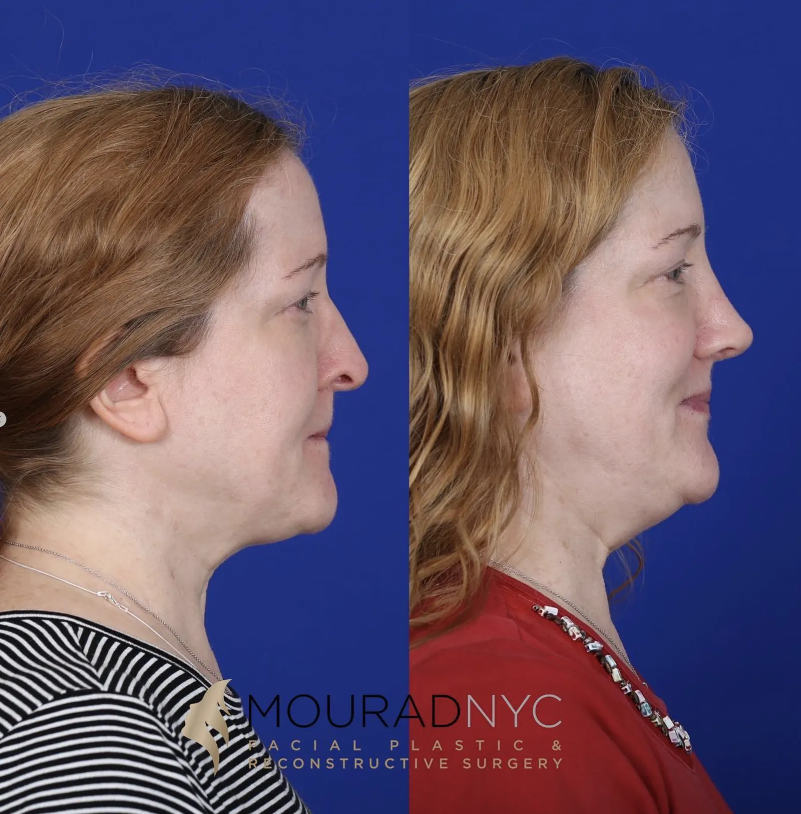 Left lateral profile comparison of a female patient in her 40s before and after primary rhinoplasty