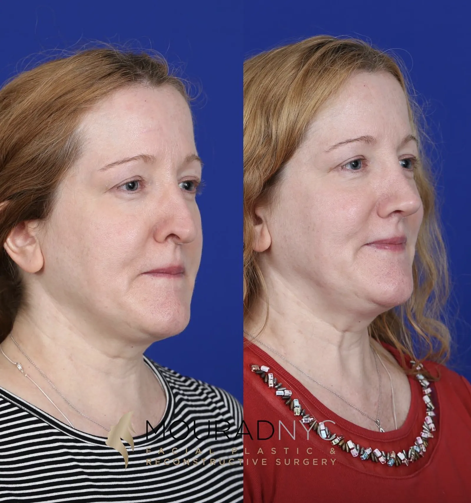 Left oblique comparison of a female patient in her 40s before and after primary rhinoplasty
