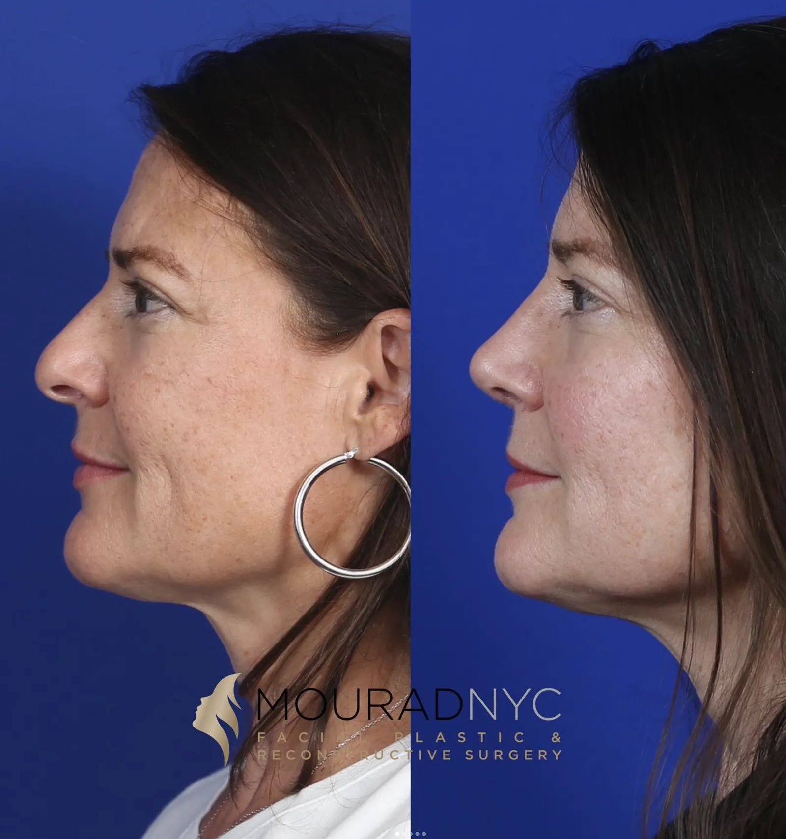 Right lateral profile comparison of female patient in her 40s before and after primary rhinoplasty with sinus surgery