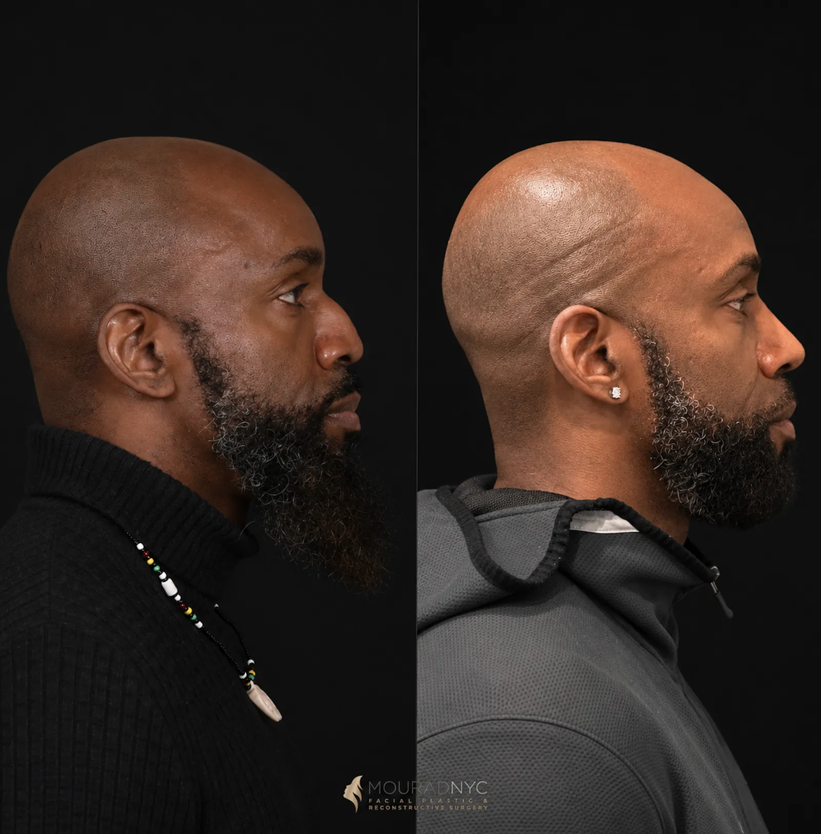 Right lateral profile comparison of a male patient in his 40s before and after ethnic rhinoplasty