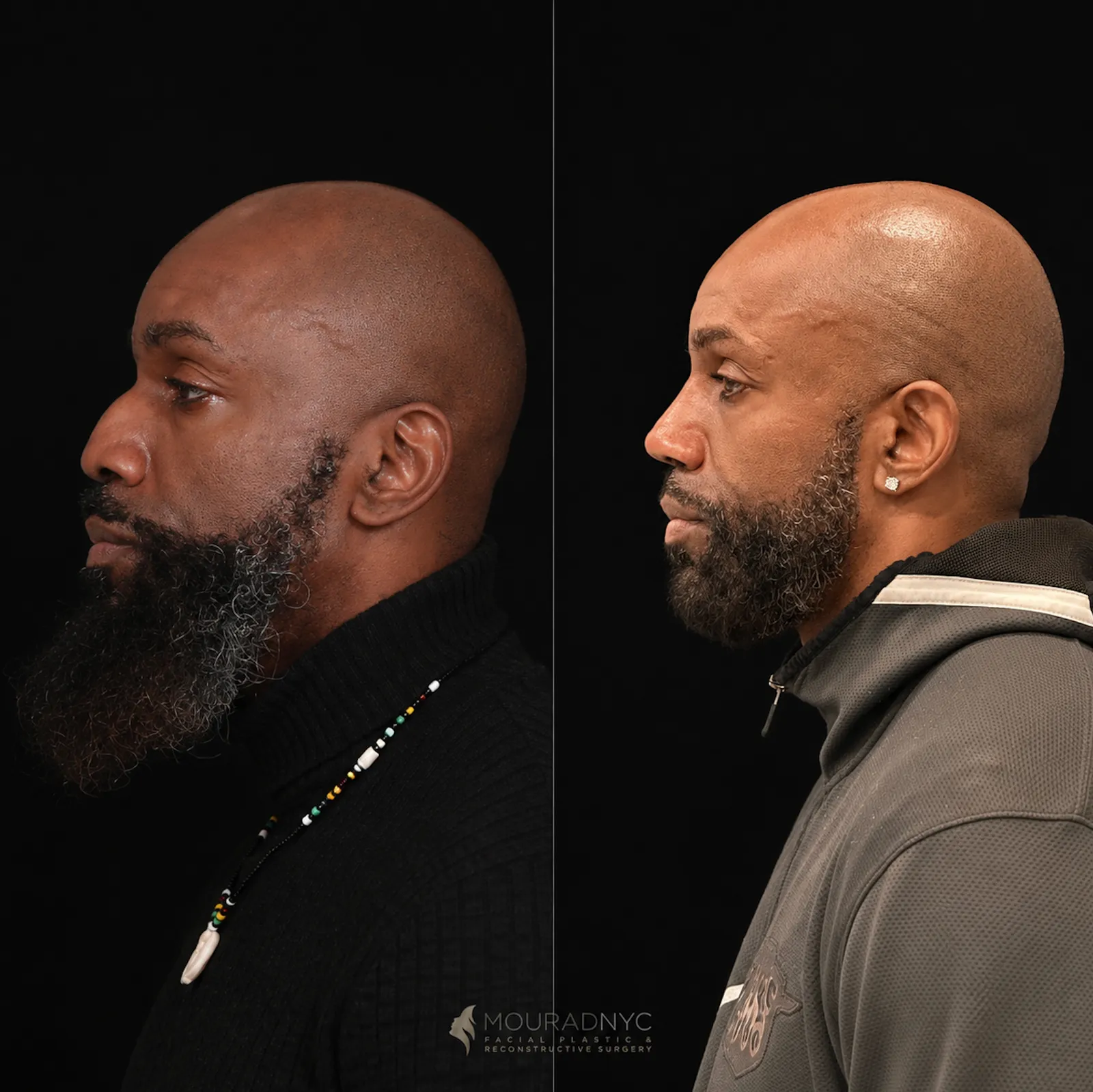 Left lateral profile comparison of a male patient in his 40s before and after ethnic rhinoplasty