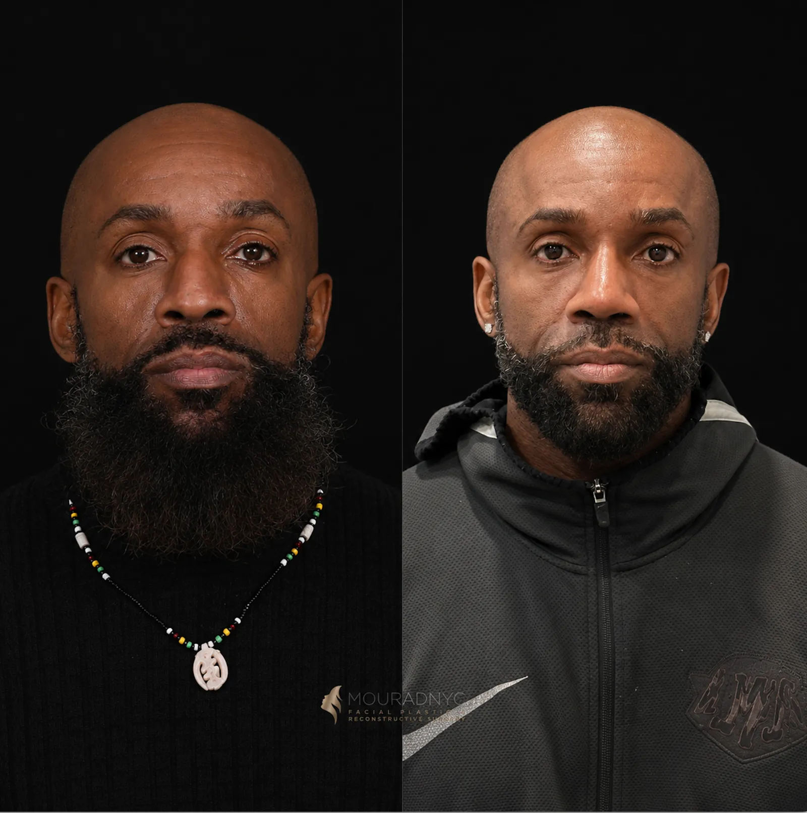 Frontal comparison of a male patient in his 40s before and after ethnic rhinoplasty