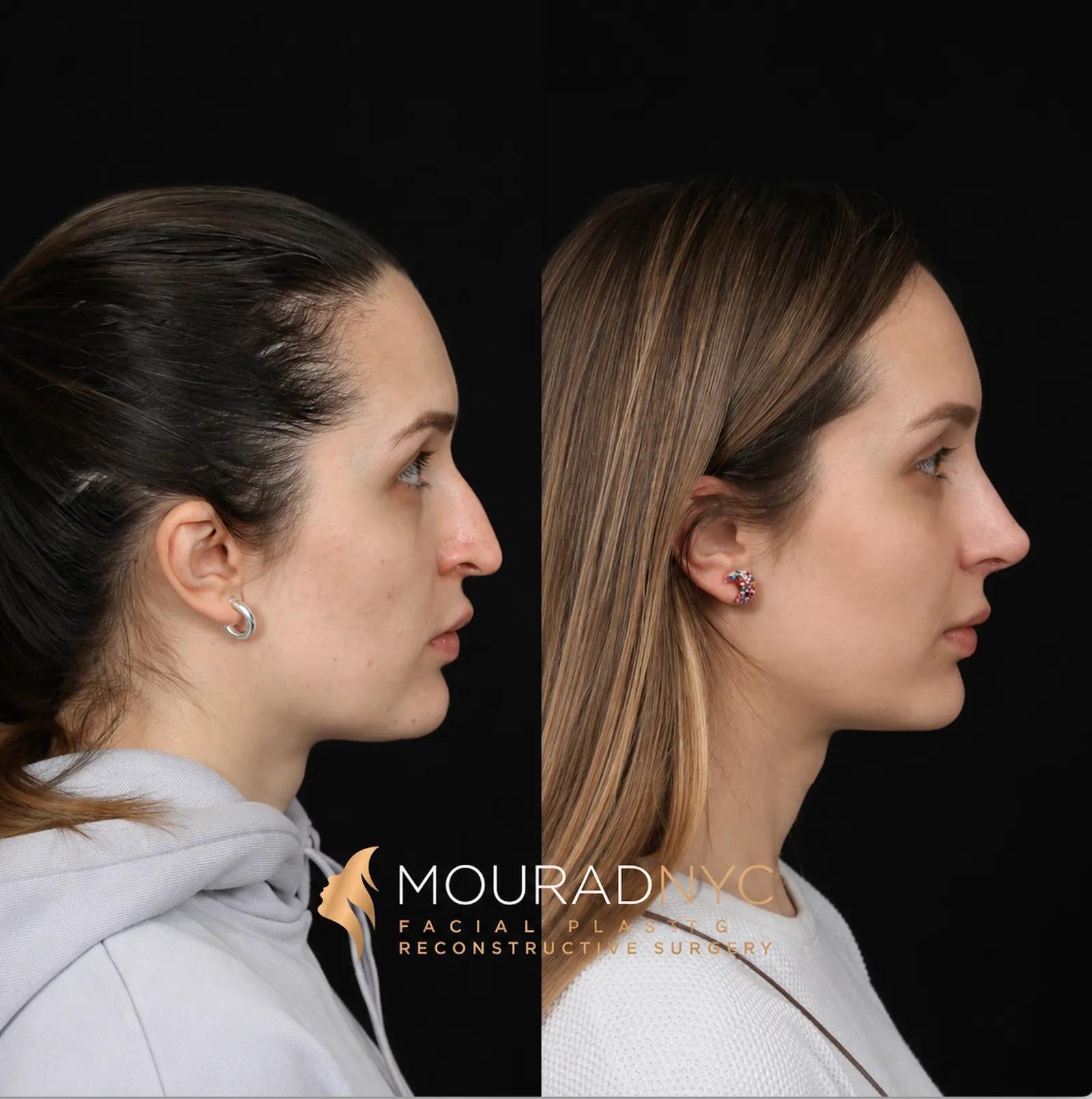 Right lateral profile comparison of a female patient in her 30s before and after revision rhinoplasty