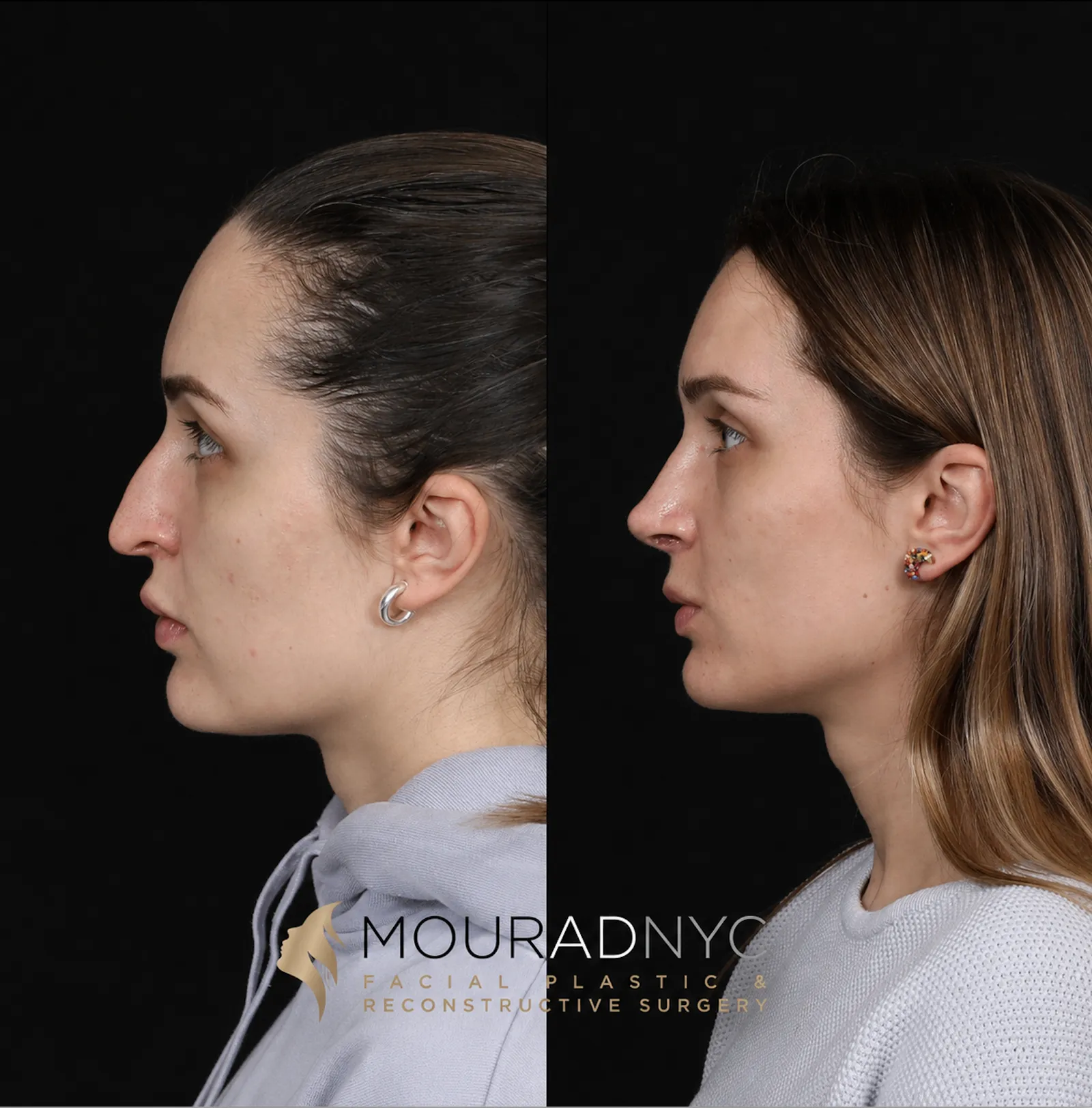 Left lateral profile comparison of a female patient in her 30s before and after revision rhinoplasty