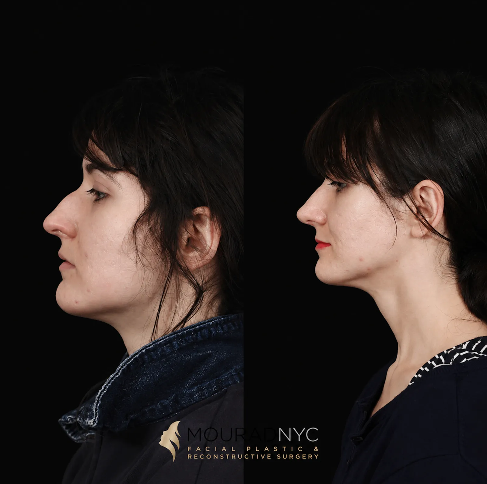 Left lateral before-and-after view of post-traumatic nasal fracture repair, female patient in her 30s