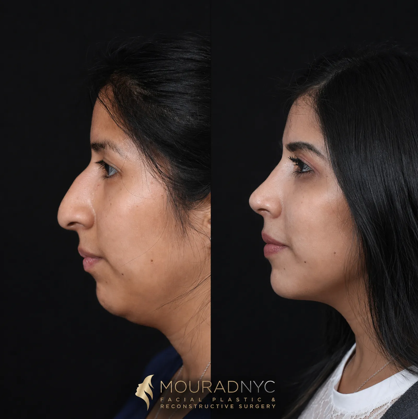 Left lateral profile comparison of female patient in her 30s before and after primary rhinoplasty