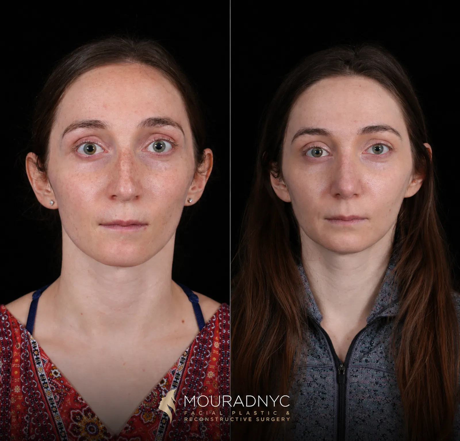 Frontal comparison of a female patient in her 20s before and after primary rhinoplasty that also addressed a nasal fracture
