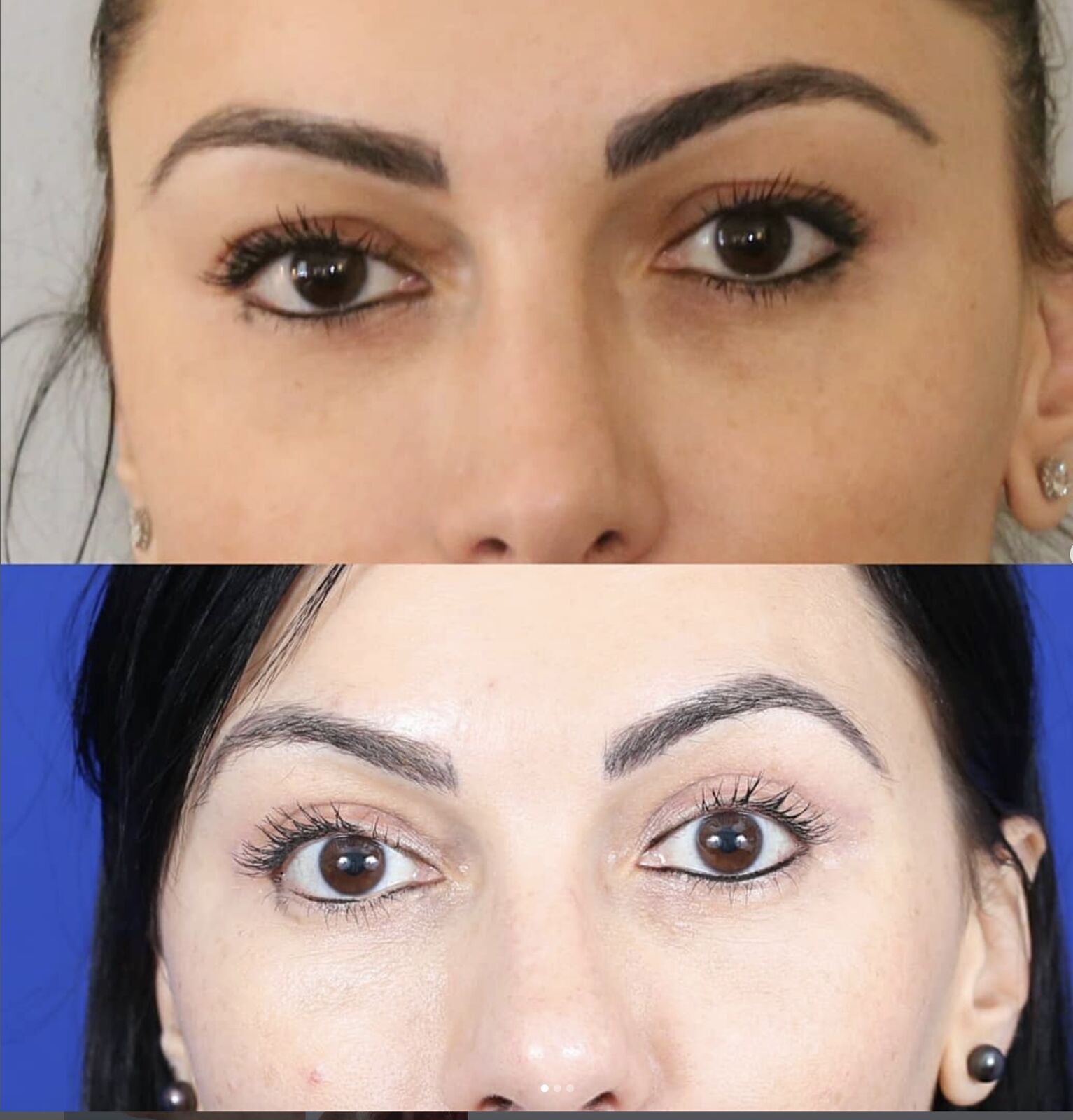 Frontal comparison of a female patient in her 30s before and after eyelid surgery (blepharoplasty)