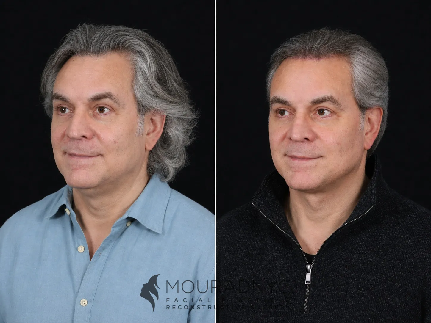 Left oblique comparison of a male patient in his 60s before and after facelift with neck lift