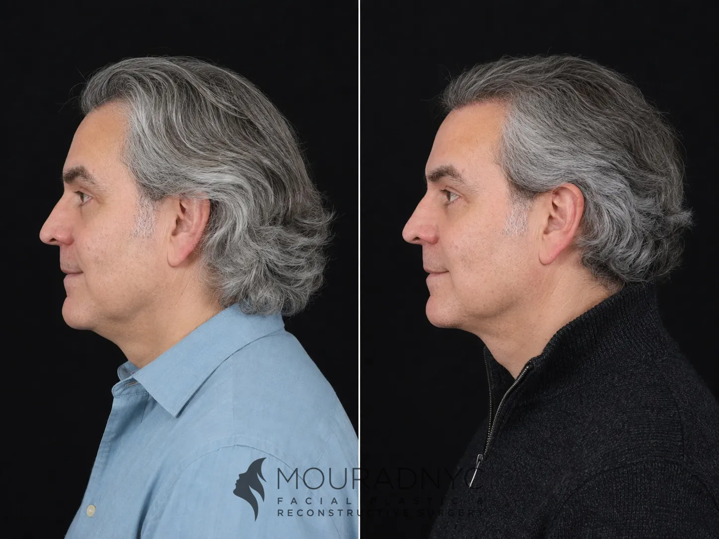 Left lateral profile comparison of a male patient in his 60s before and after facelift with neck lift