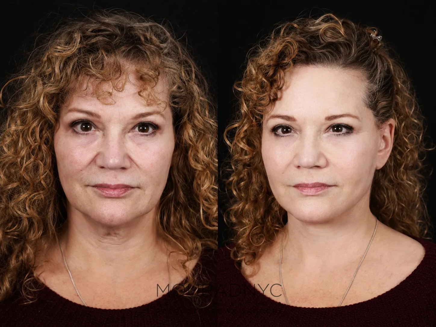 Frontal comparison of a female patient in her 50s before and after facelift with neck lift and blepharoplasty