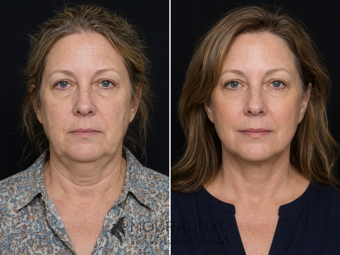 Frontal comparison of a female patient in her 50s before and after facelift with neck lift