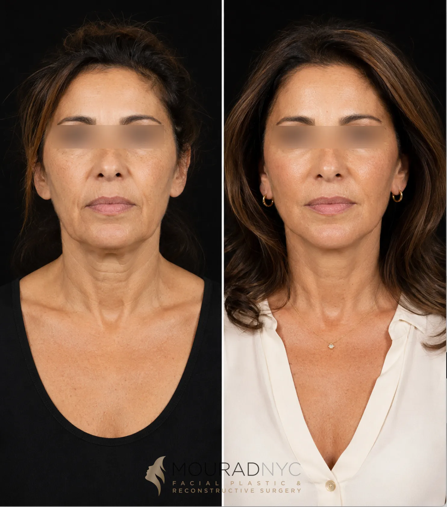 Frontal comparison of a female patient in her 50s before and after a primary facelift