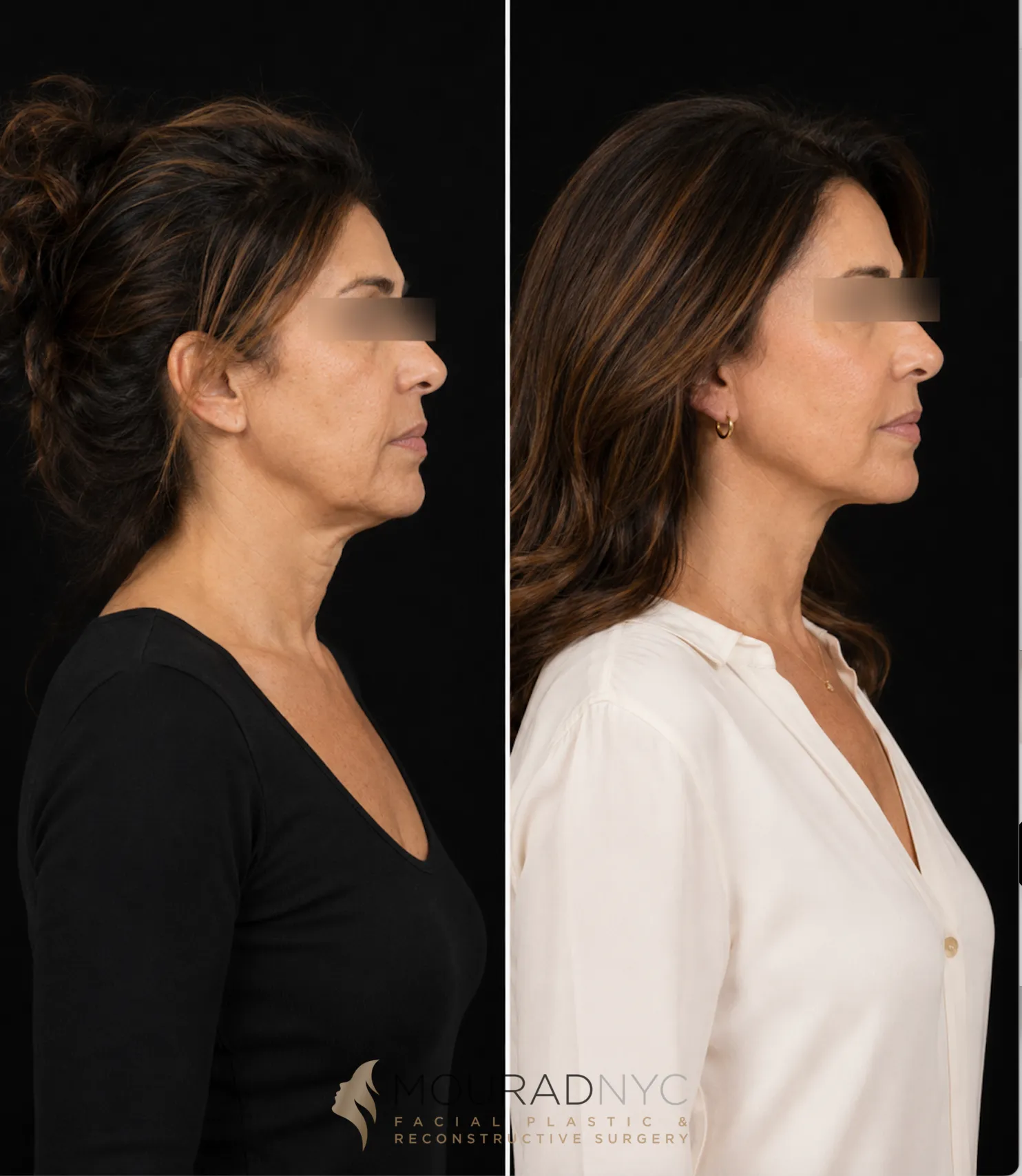 Right lateral profile comparison of a female patient in her 50s before and after a primary facelift