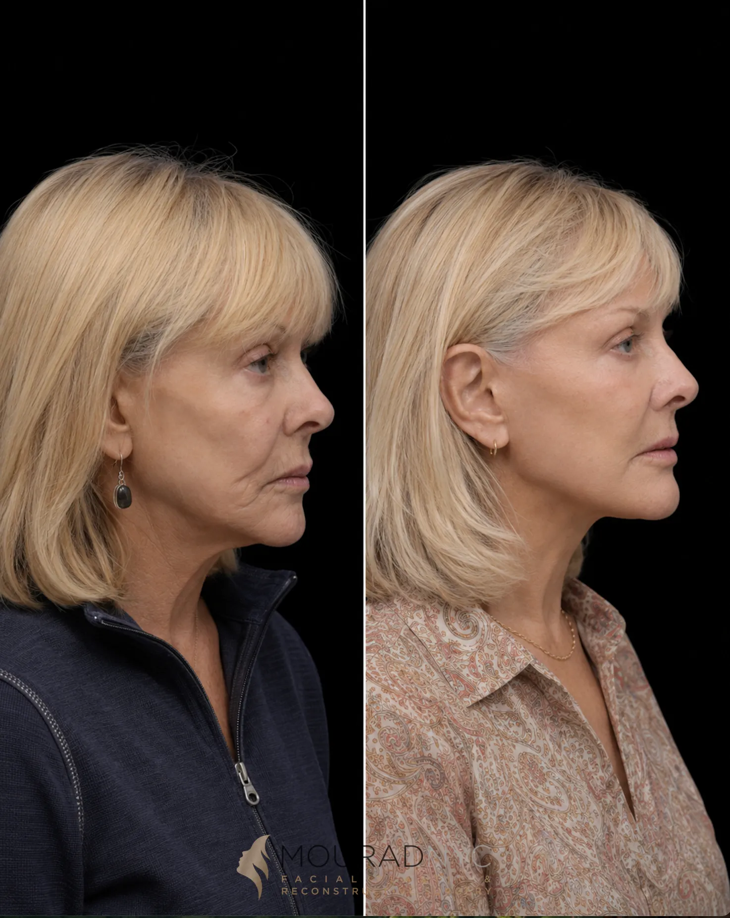 Right lateral profile comparison of a female patient in her 70s before and after revision facelift with neck lift