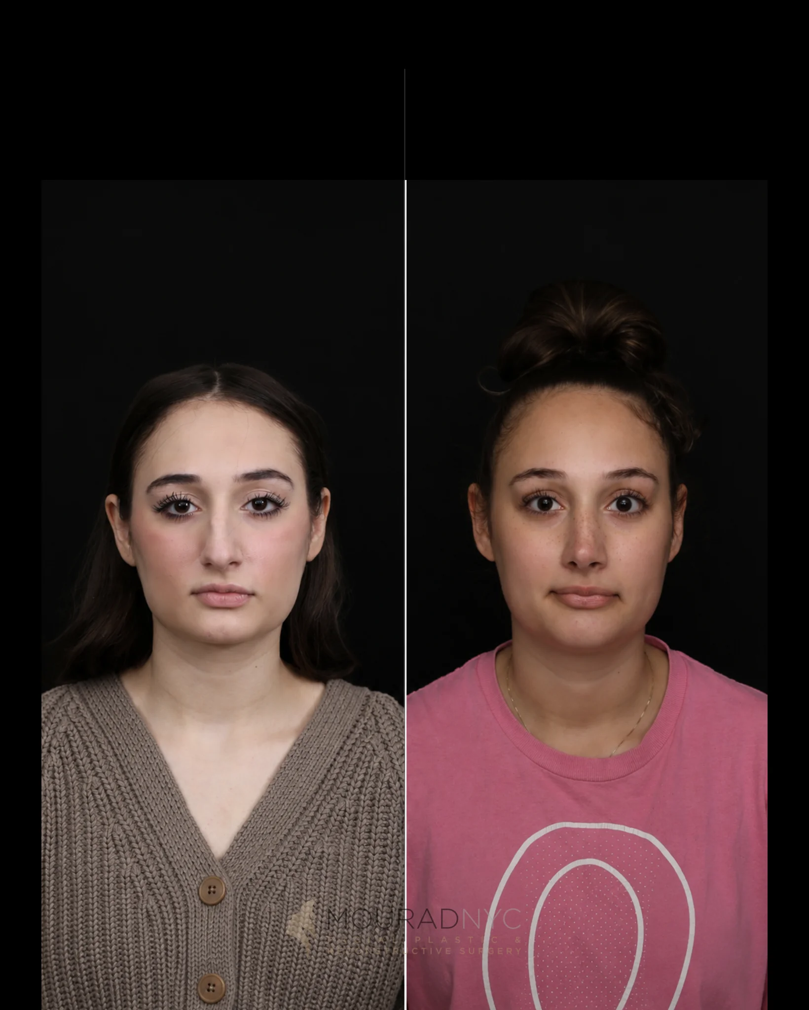 Frontal comparison of a female patient in her 20s before and after primary rhinoplasty