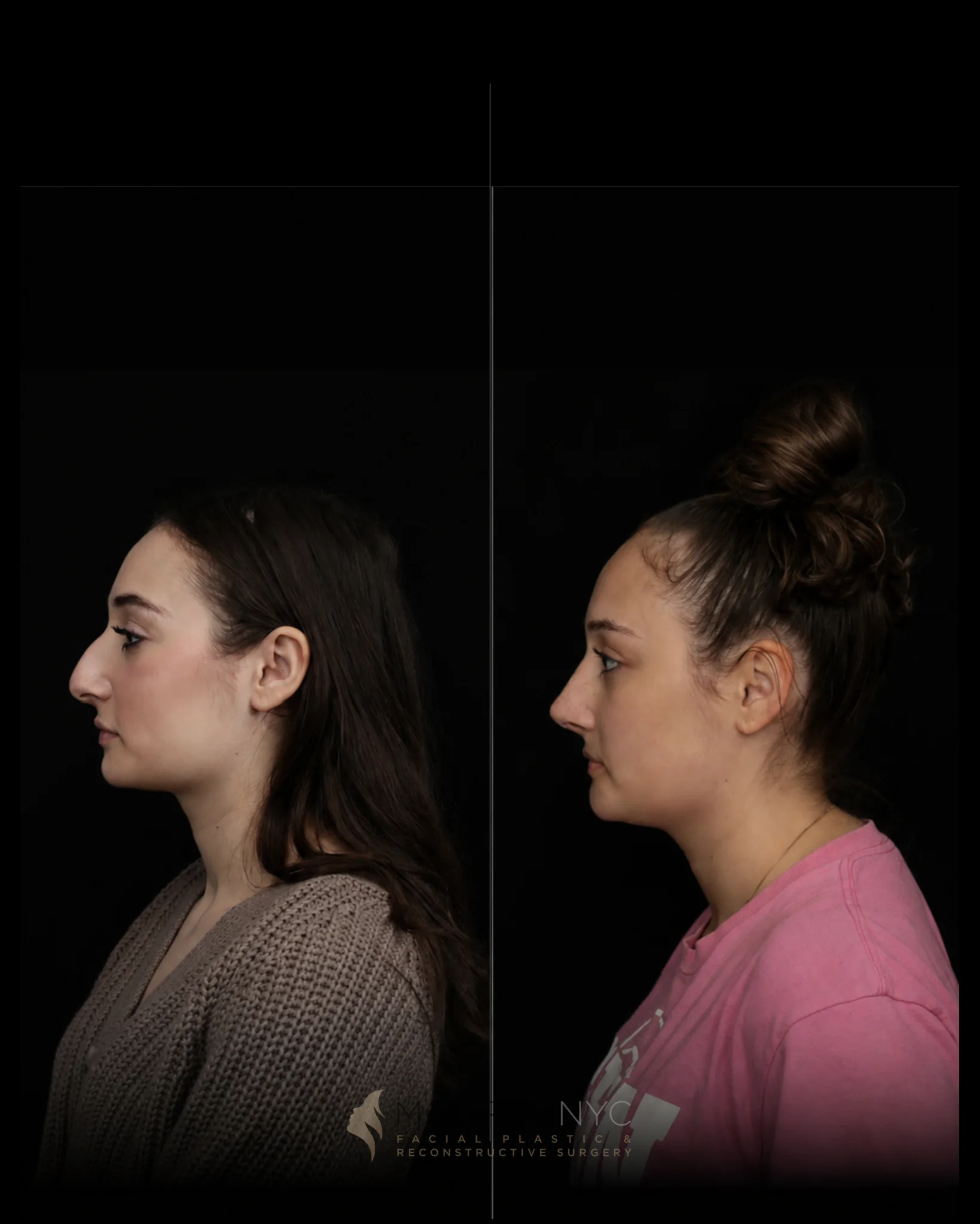 Left lateral profile comparison of a female patient in her 20s before and after primary rhinoplasty