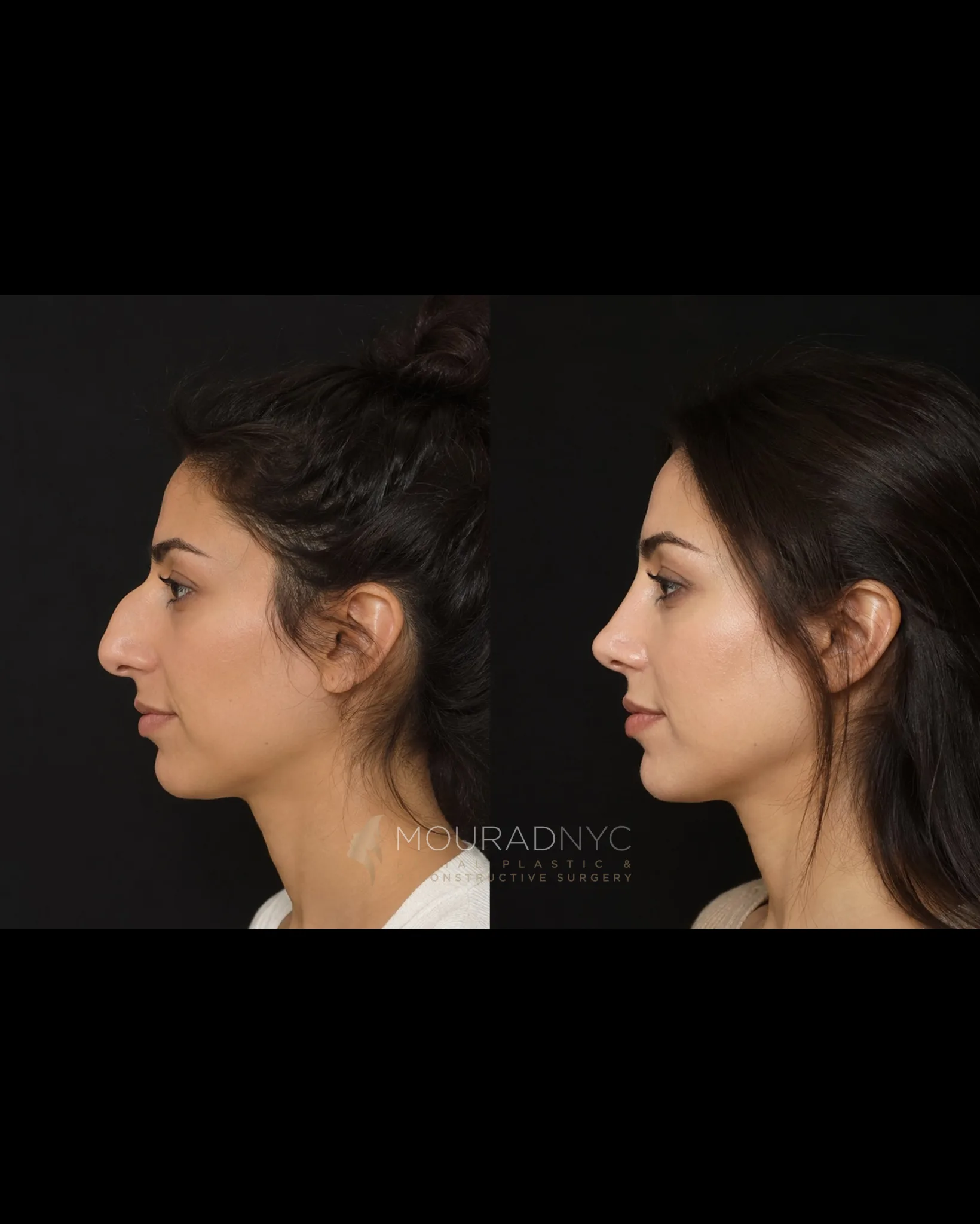 Left lateral profile comparison of a female patient in her 20s before and after primary rhinoplasty