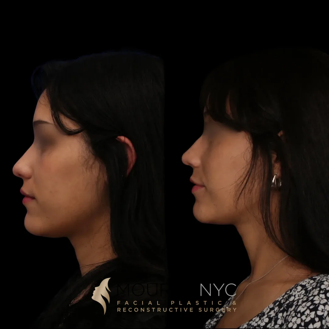 Left lateral profile comparison of a female patient in her 20s before and after primary rhinoplasty