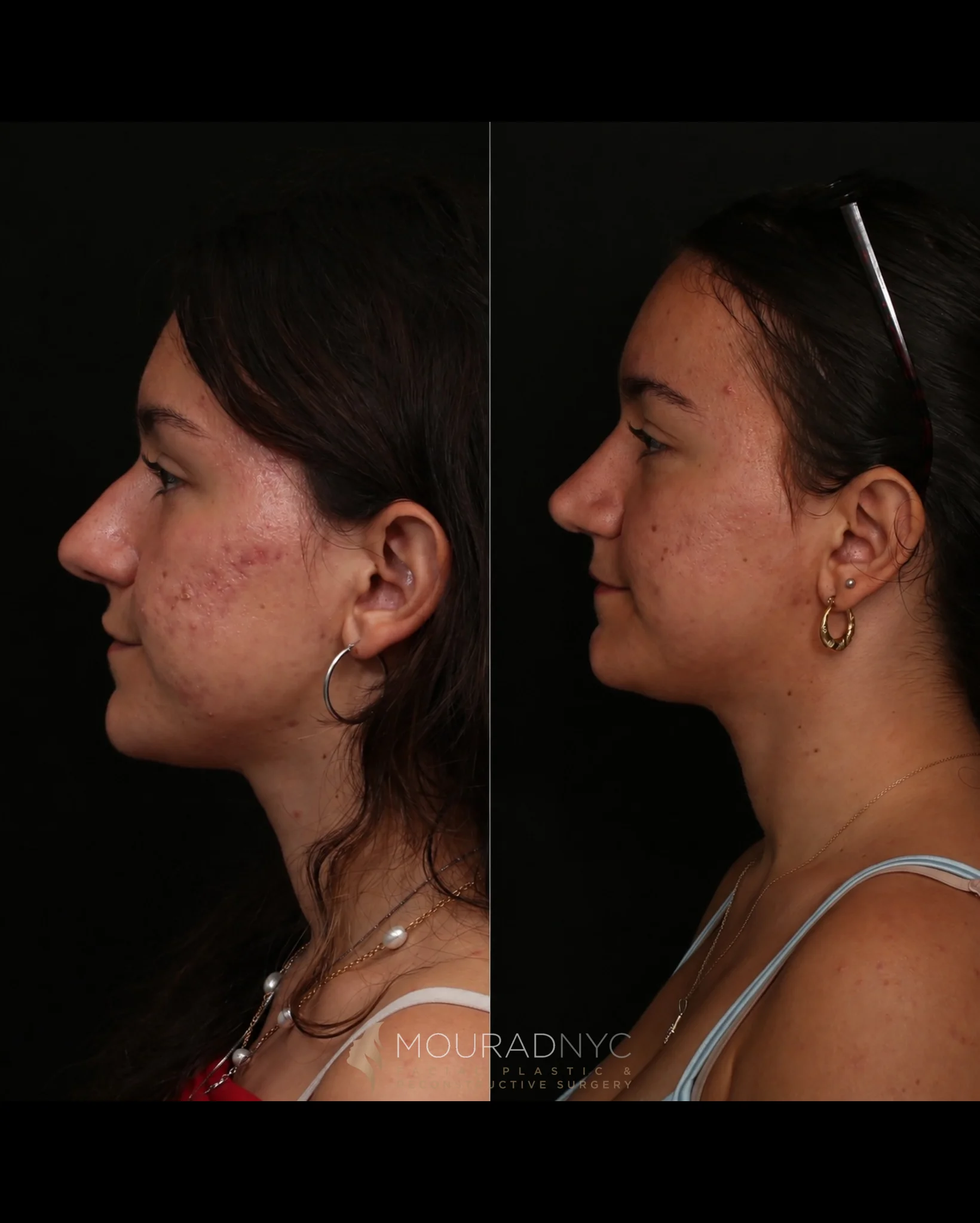 Left lateral profile comparison of a female patient in her 20s before and after preservation rhinoplasty