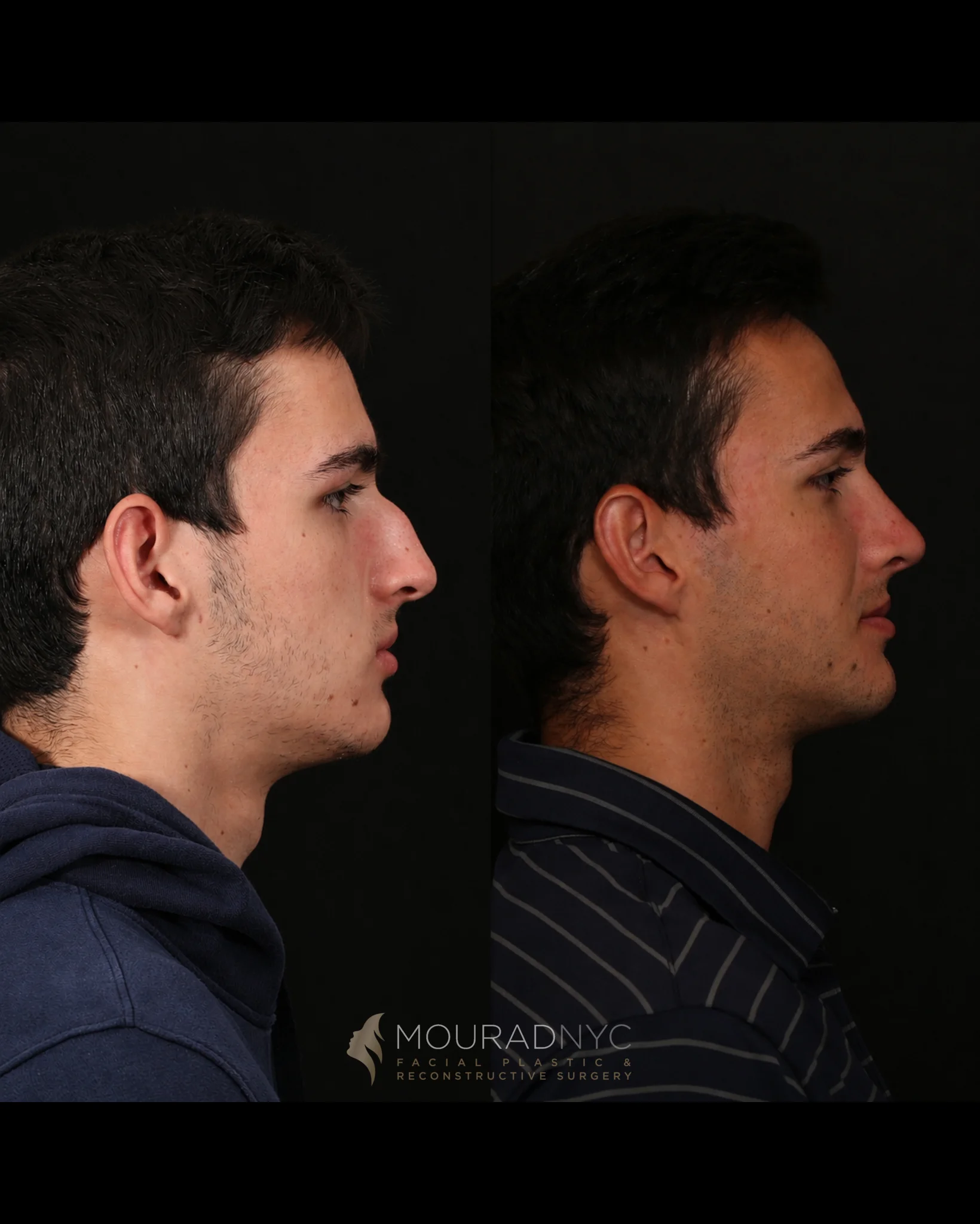 Right lateral profile comparison of a male patient before primary rhinoplasty at age 17 and five years after surgery