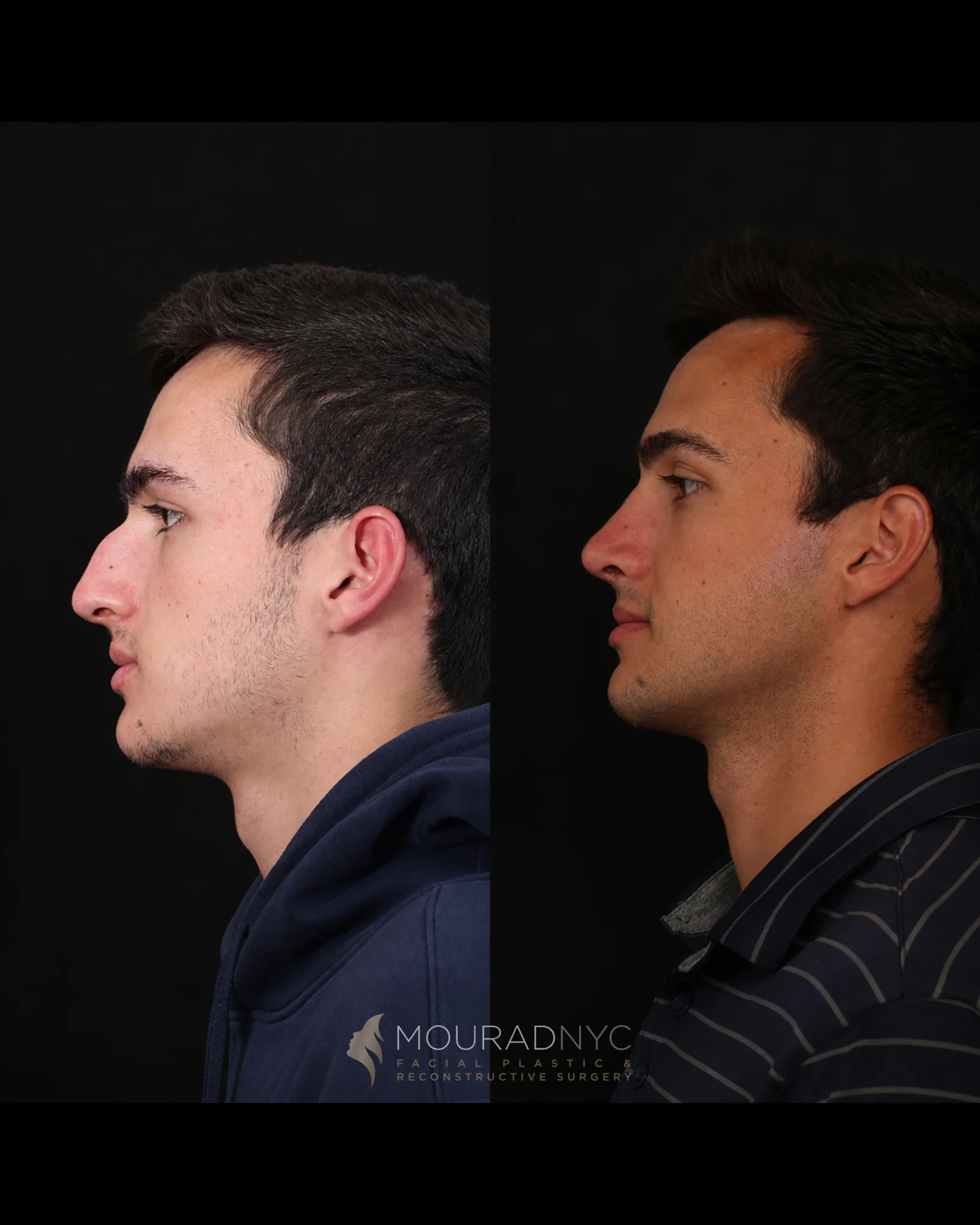 Left lateral profile comparison of a male patient before primary rhinoplasty at age 17 and five years after surgery