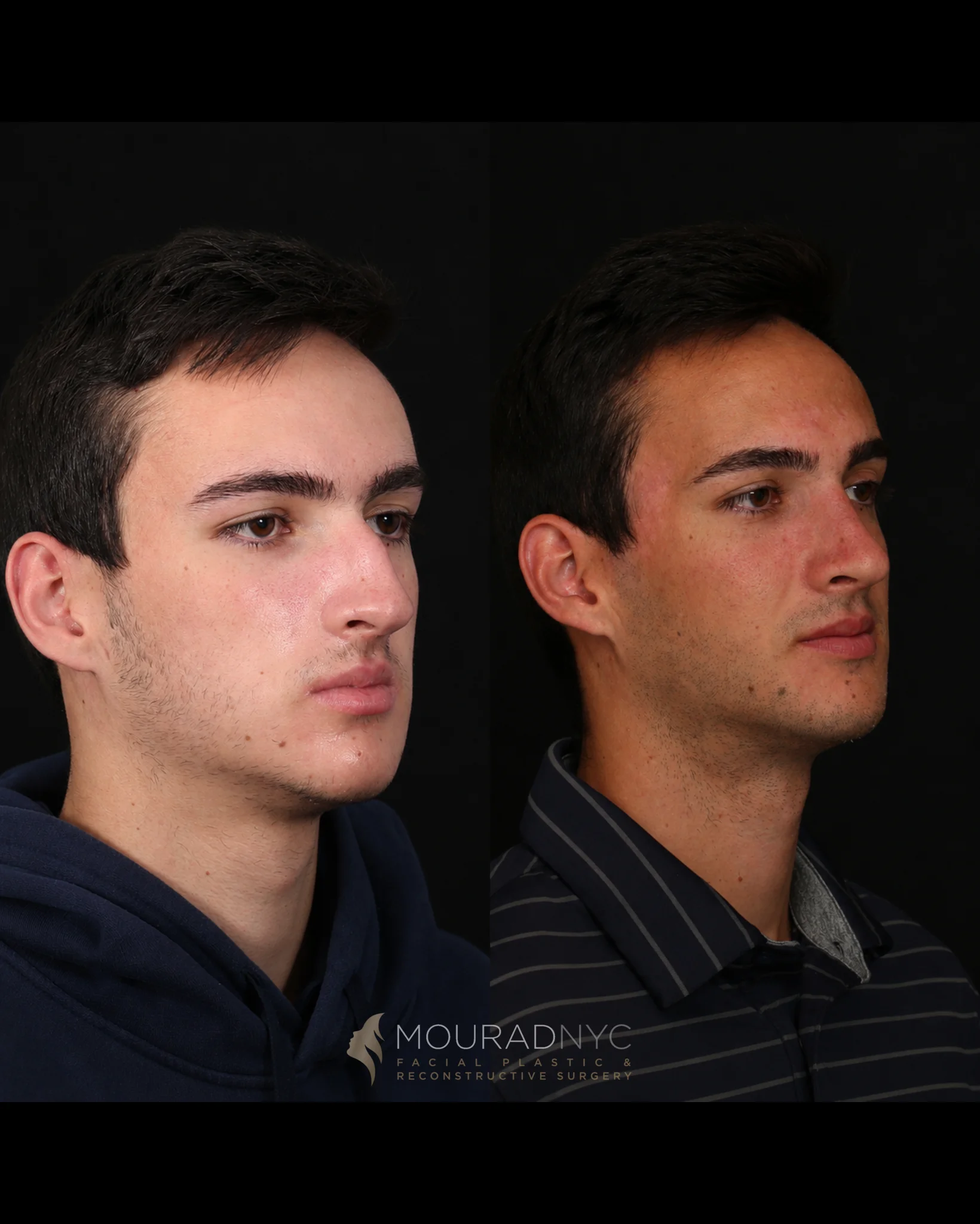 Right three-quarter comparison of a male patient before primary rhinoplasty at age 17 and five years after surgery