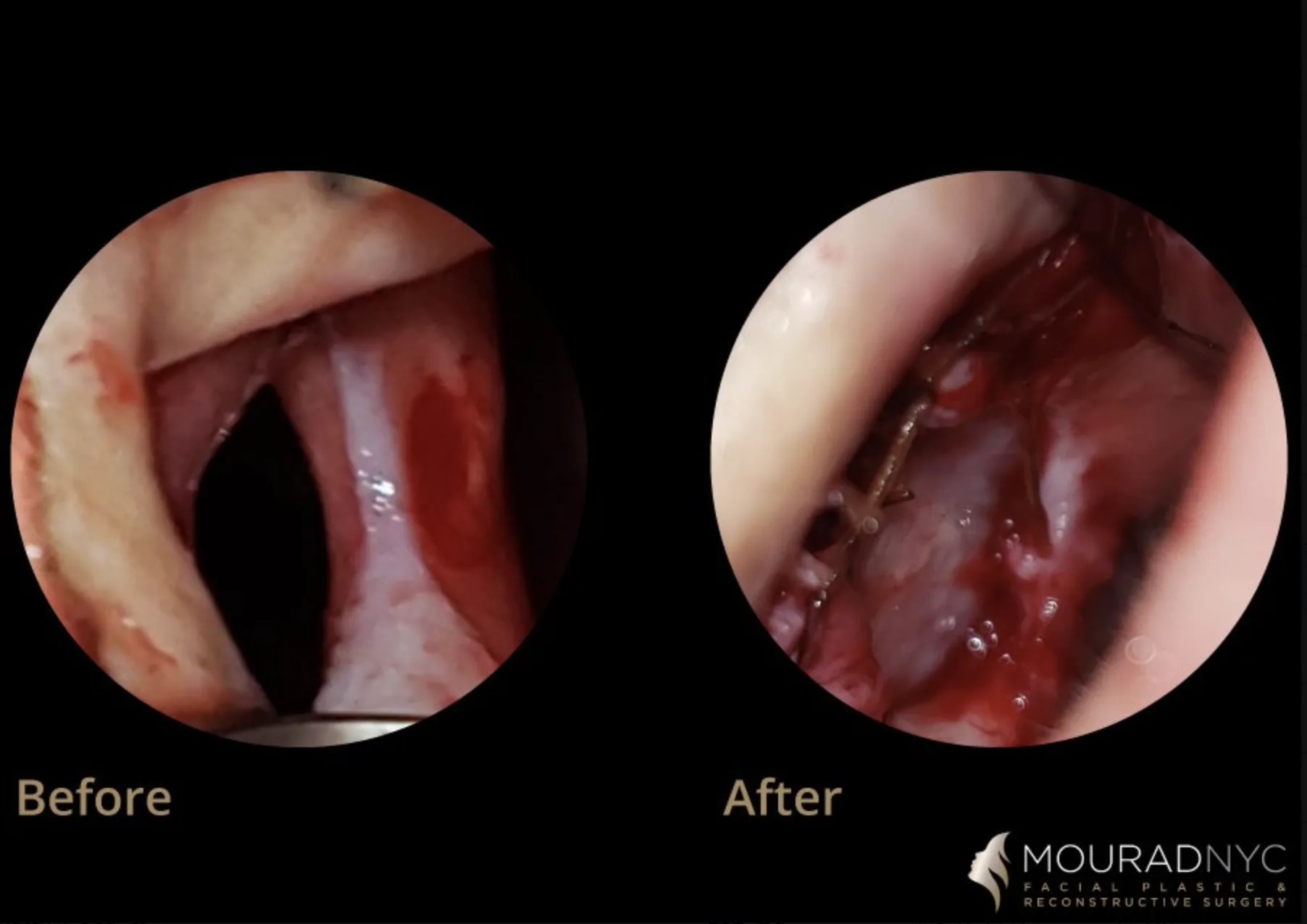 Endoscopic before and after comparison of a septal perforation repair showing the perforation before surgery and the closed septum after repair