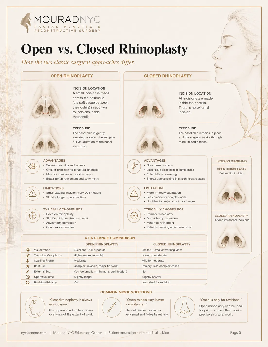 Rhinoplasty Guide — page 5: Open vs. Closed Rhinoplasty