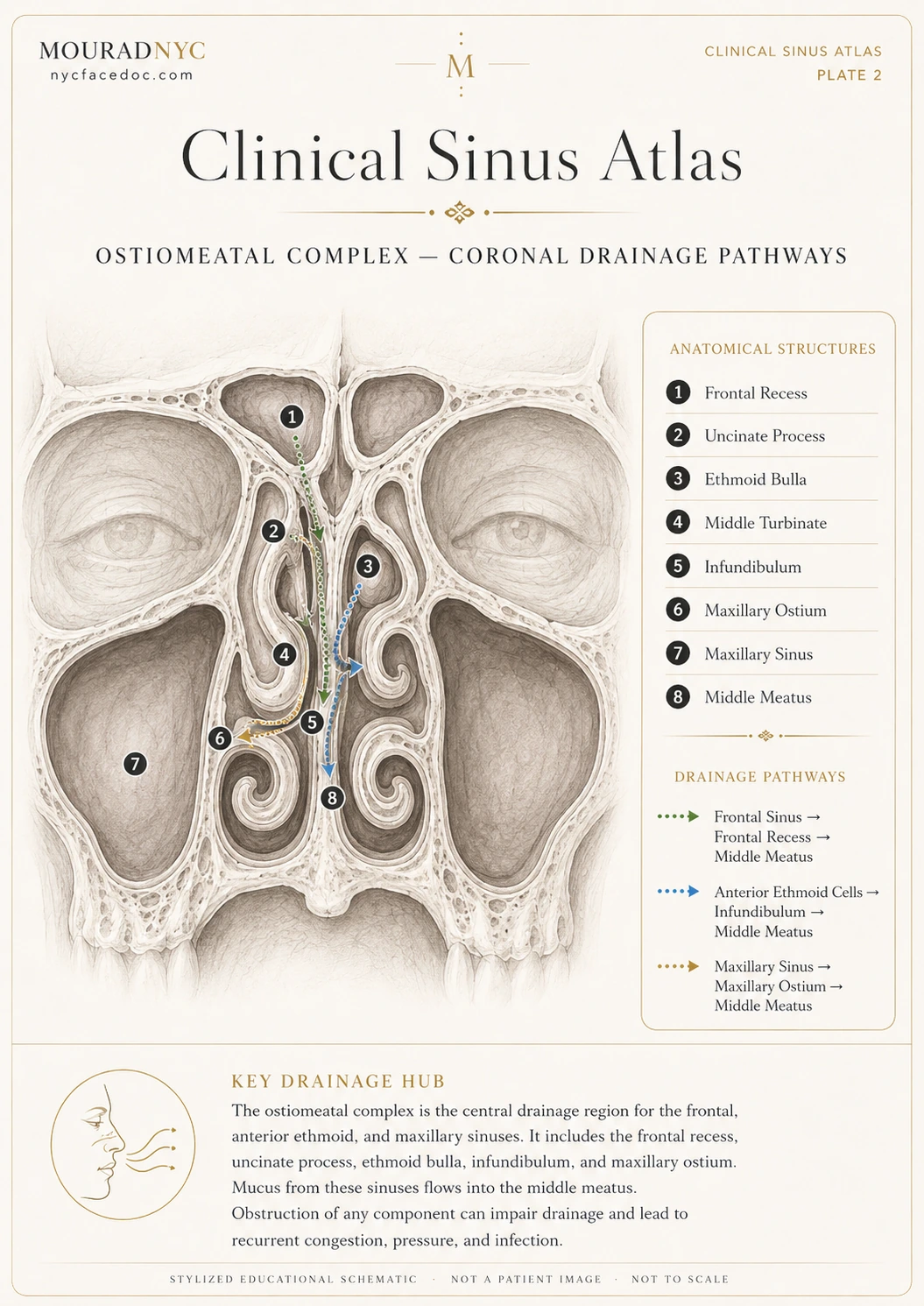 Clinical sinus atlas plate showing the ostiomeatal complex in coronal view, including frontal recess, uncinate process, ethmoid bulla, infundibulum, maxillary ostium, and middle meatus.