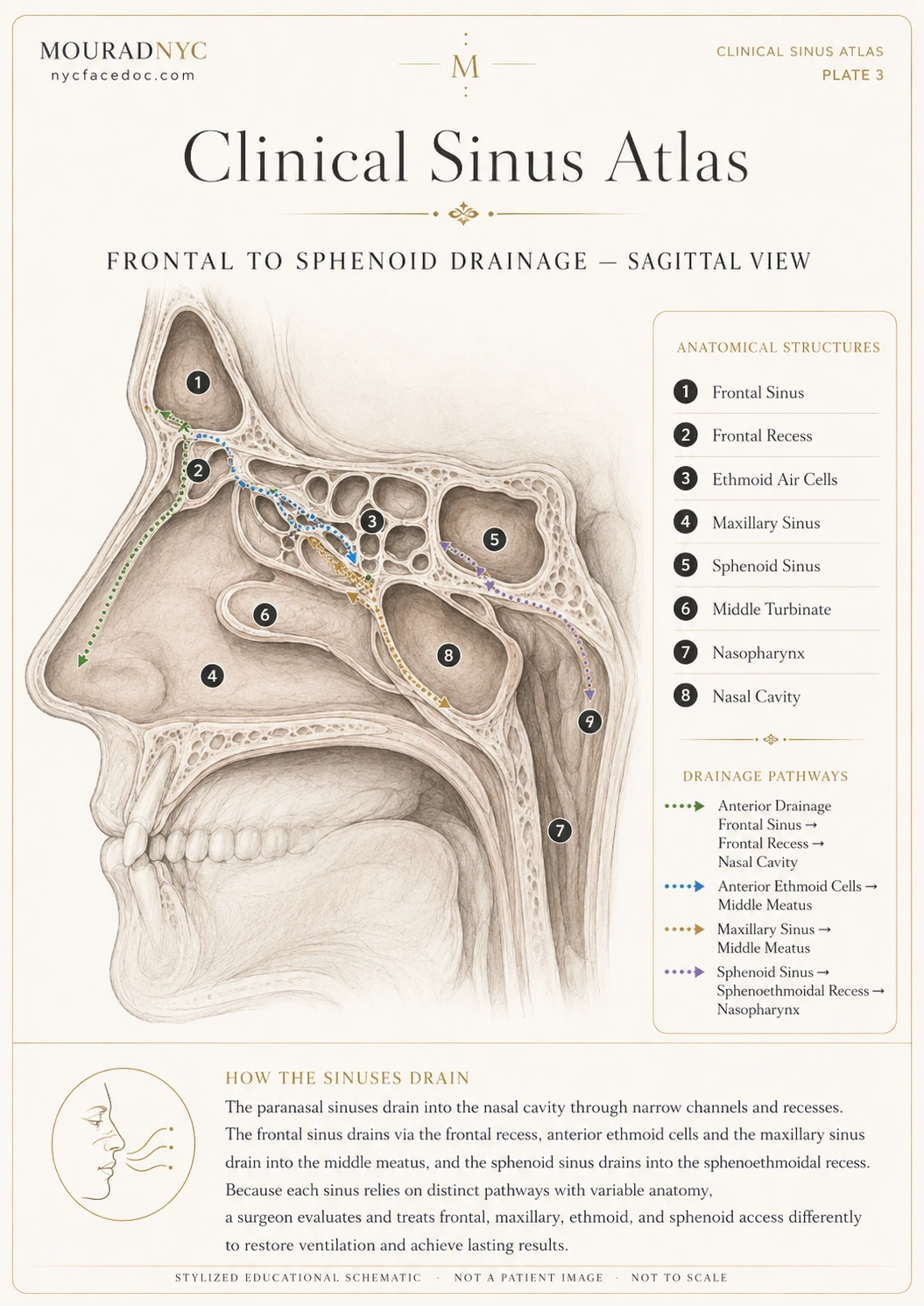 Clinical sinus atlas plate showing frontal, ethmoid, maxillary, and sphenoid sinus drainage pathways in sagittal view.