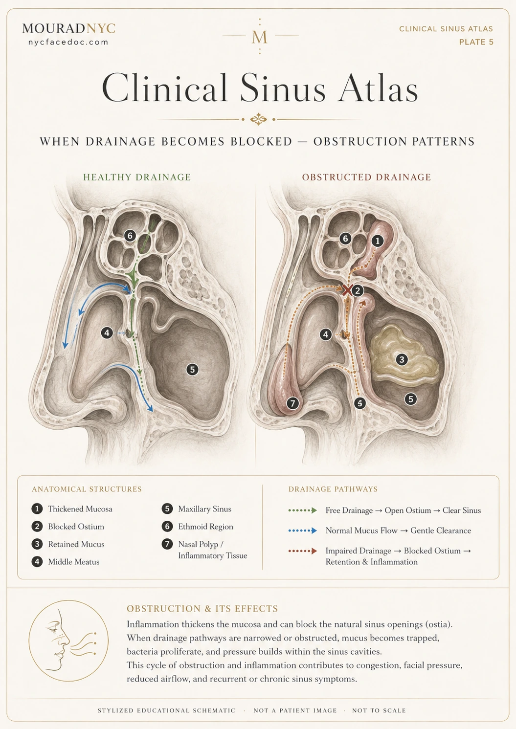 Clinical sinus atlas plate comparing healthy sinus drainage with obstructed drainage patterns caused by thickened mucosa, blocked ostium, retained mucus, and inflammatory tissue.