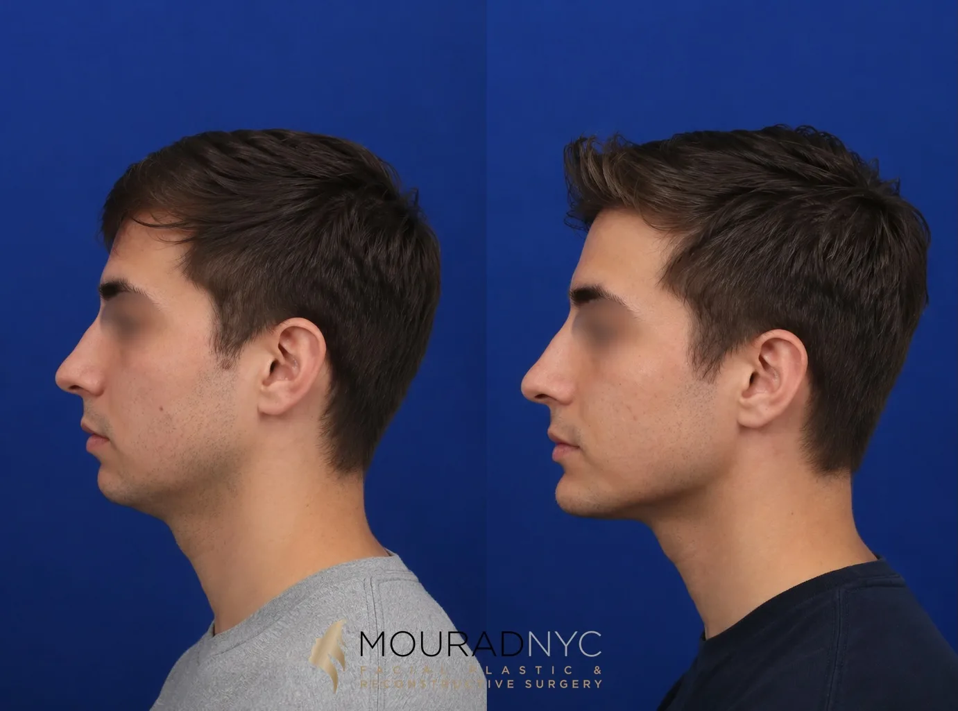 Left lateral profile comparison of a male patient in his 20s before and after sliding genioplasty