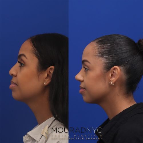Before and After Rhinoplasty