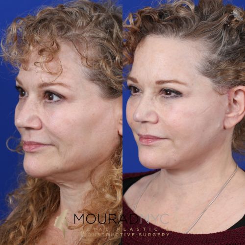 Female Facelift Before and After